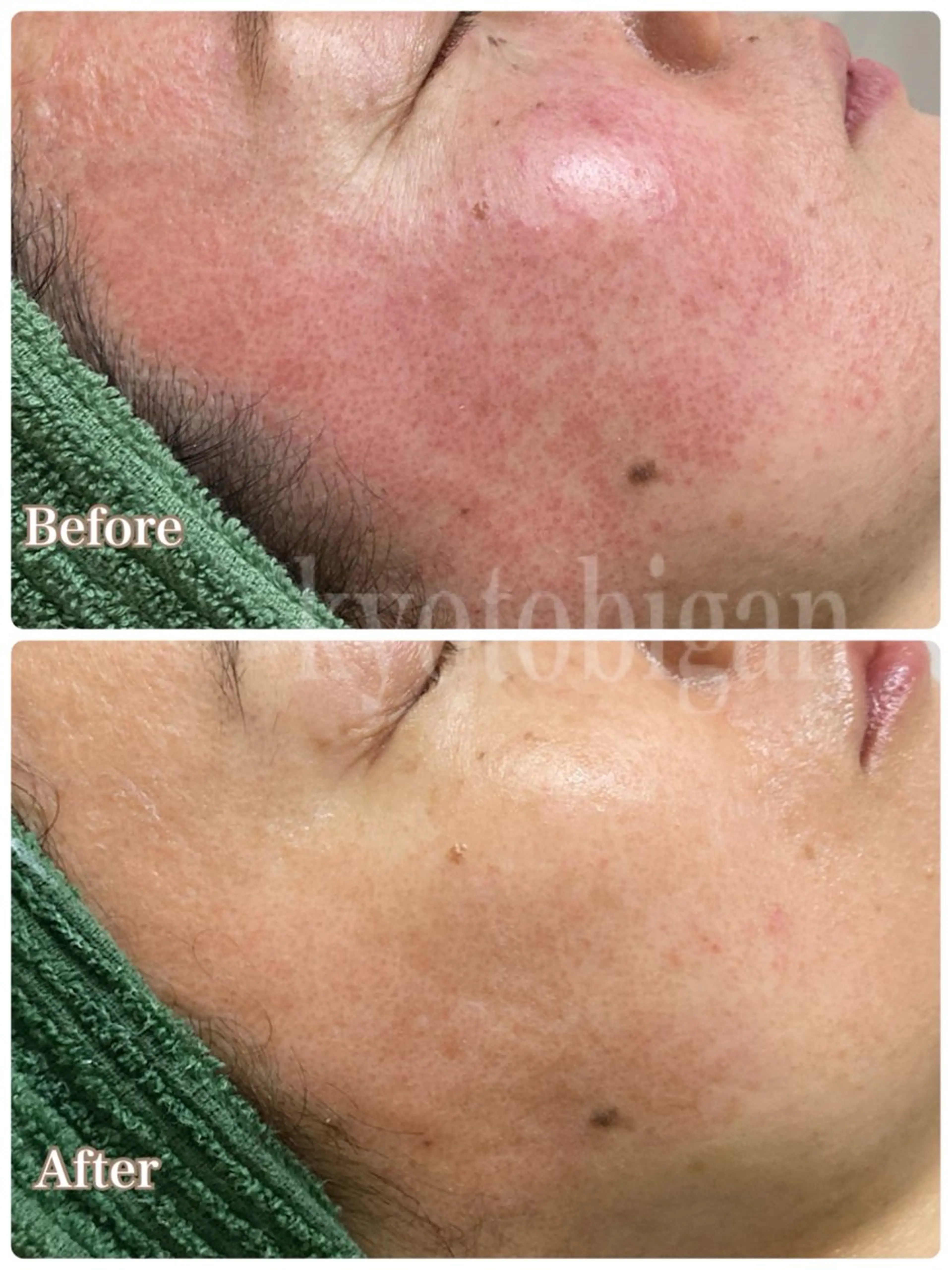 本気の敏感肌・赤み肌ケア（70分）乾燥肌・敏感肌のカウンセリング+施術の写真