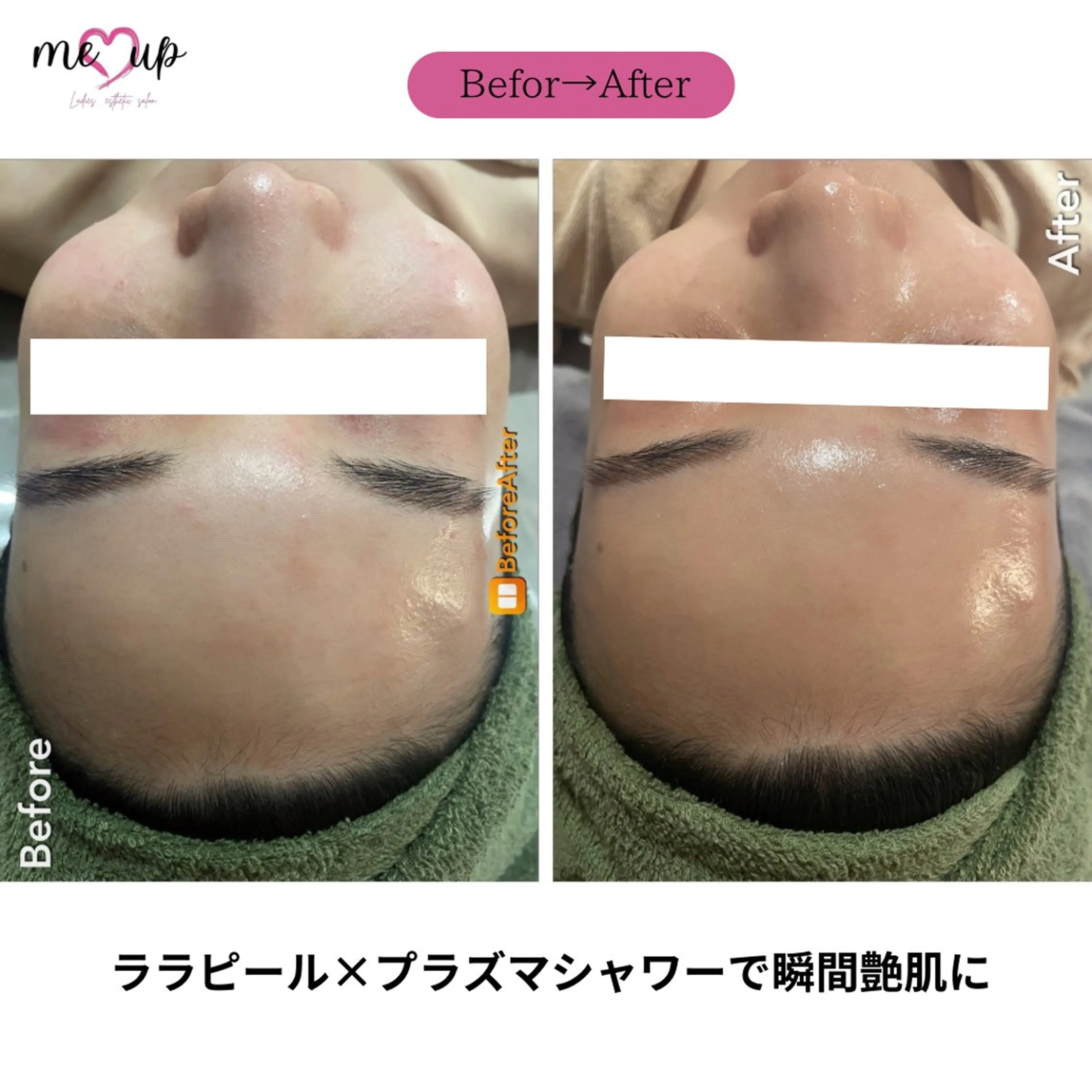 エステ Meupニキビ専門店 背中/ハーブ/肌管理のその他イメージ