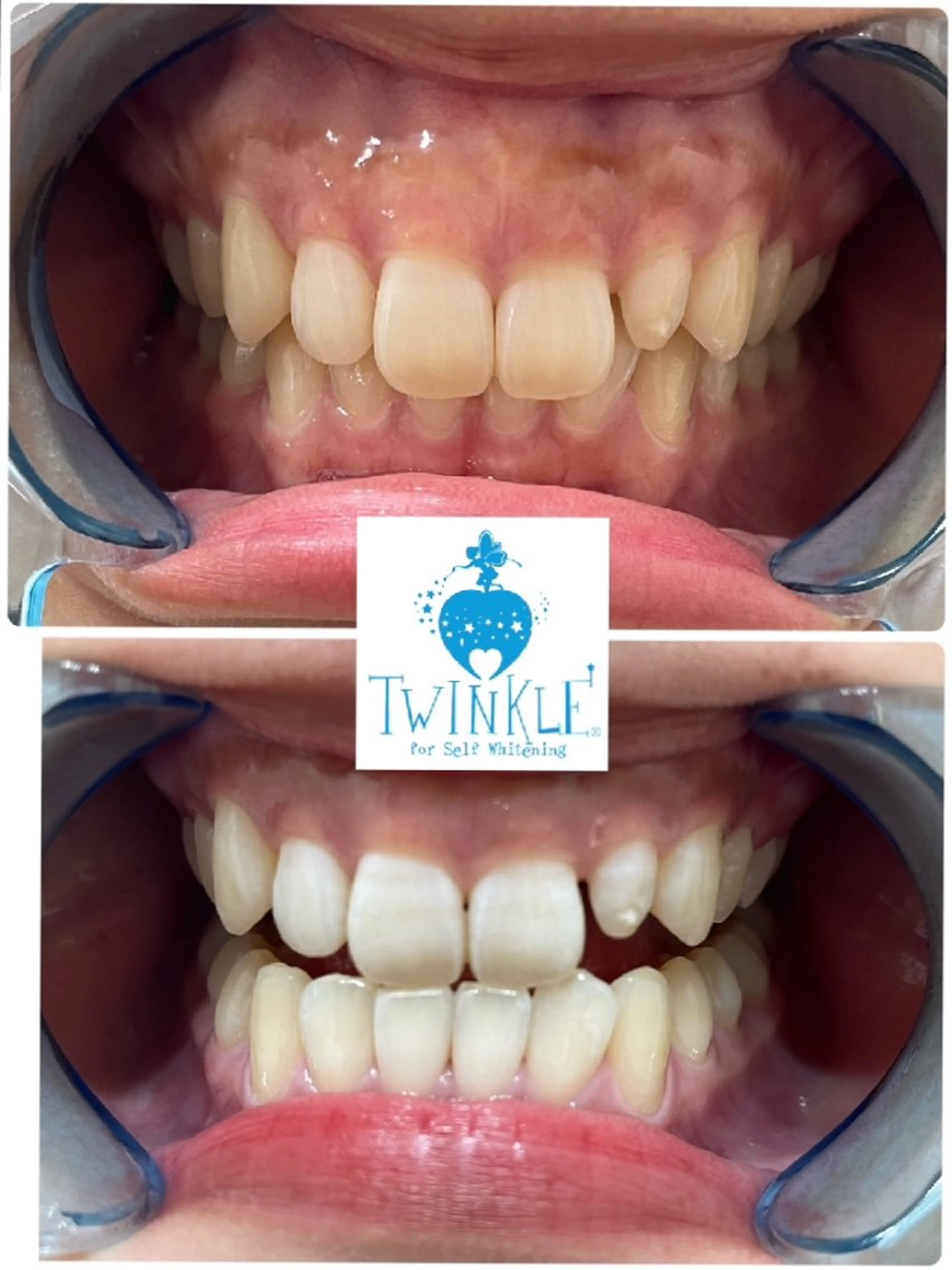 ✨当店おすすめ！セルフホワイトニング　ライトプラン　8分☓3回の写真