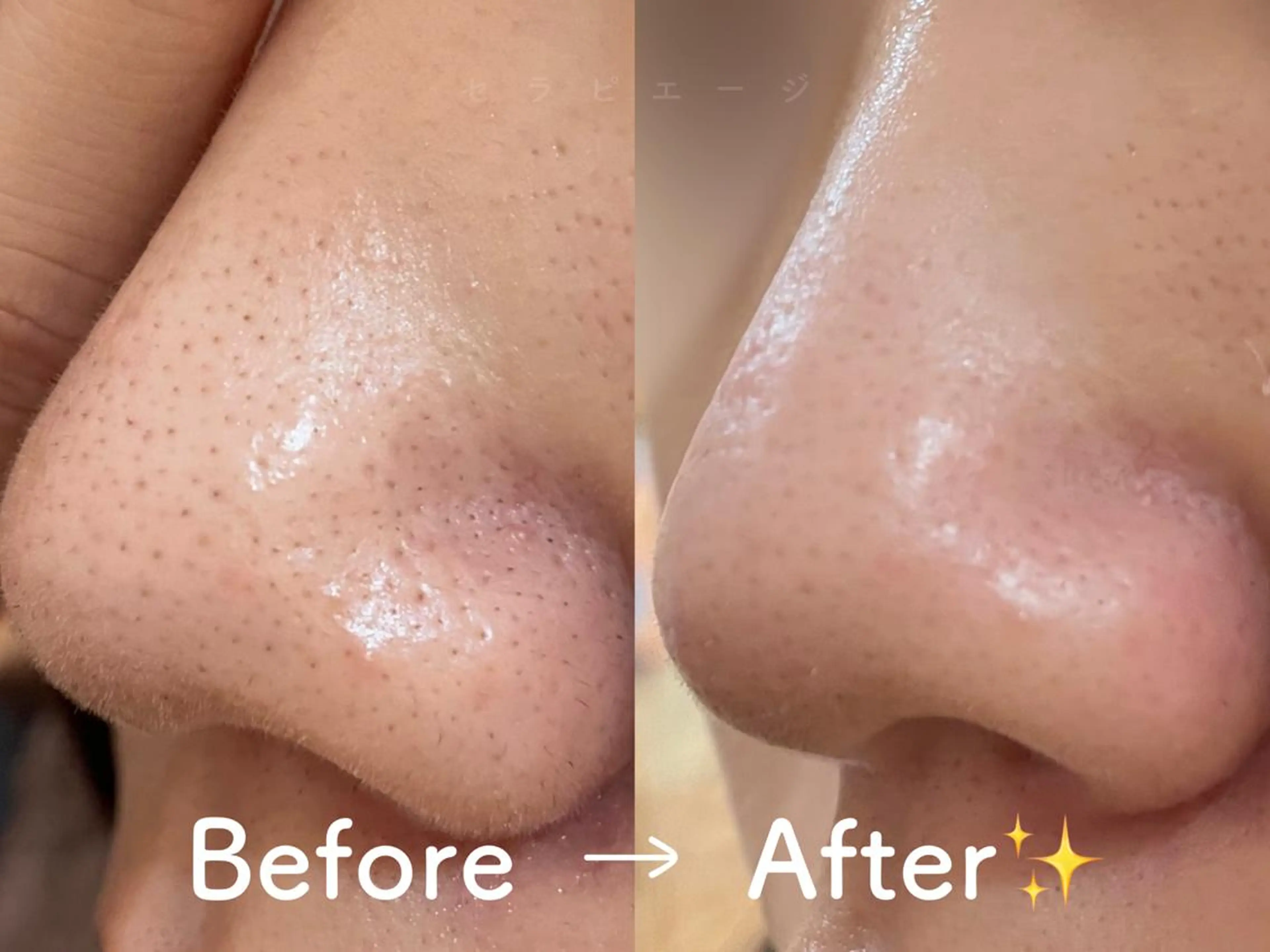 【溜まった毛穴汚れ一掃‼🌀】毛穴洗浄ハイドラフェイシャル(美容液ピーリング)【毛穴・ニキビ・小じわ・肌質改善】の写真