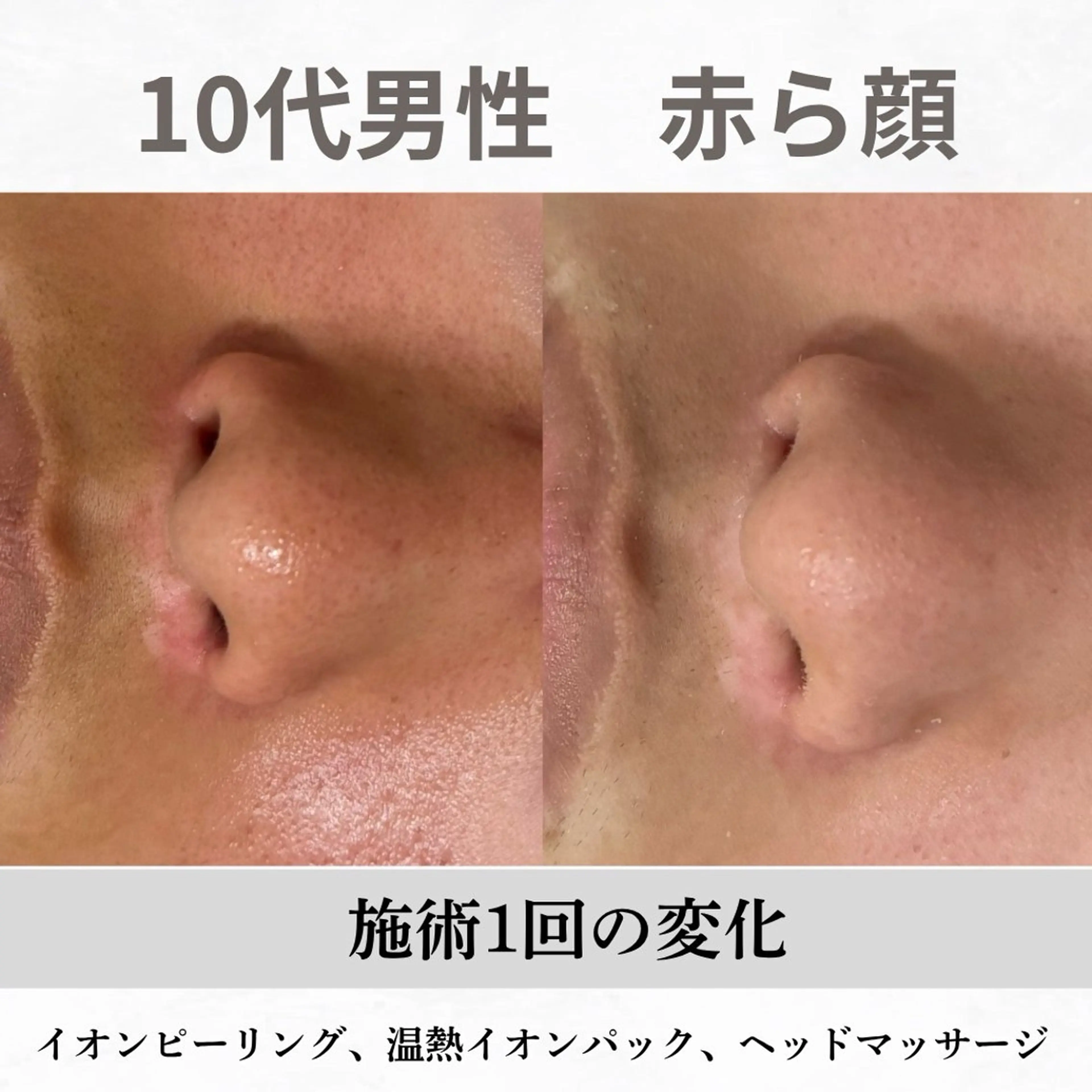 重度ニキビ専門🌷 ダウンタイムなしのエステ・リラクイメージ