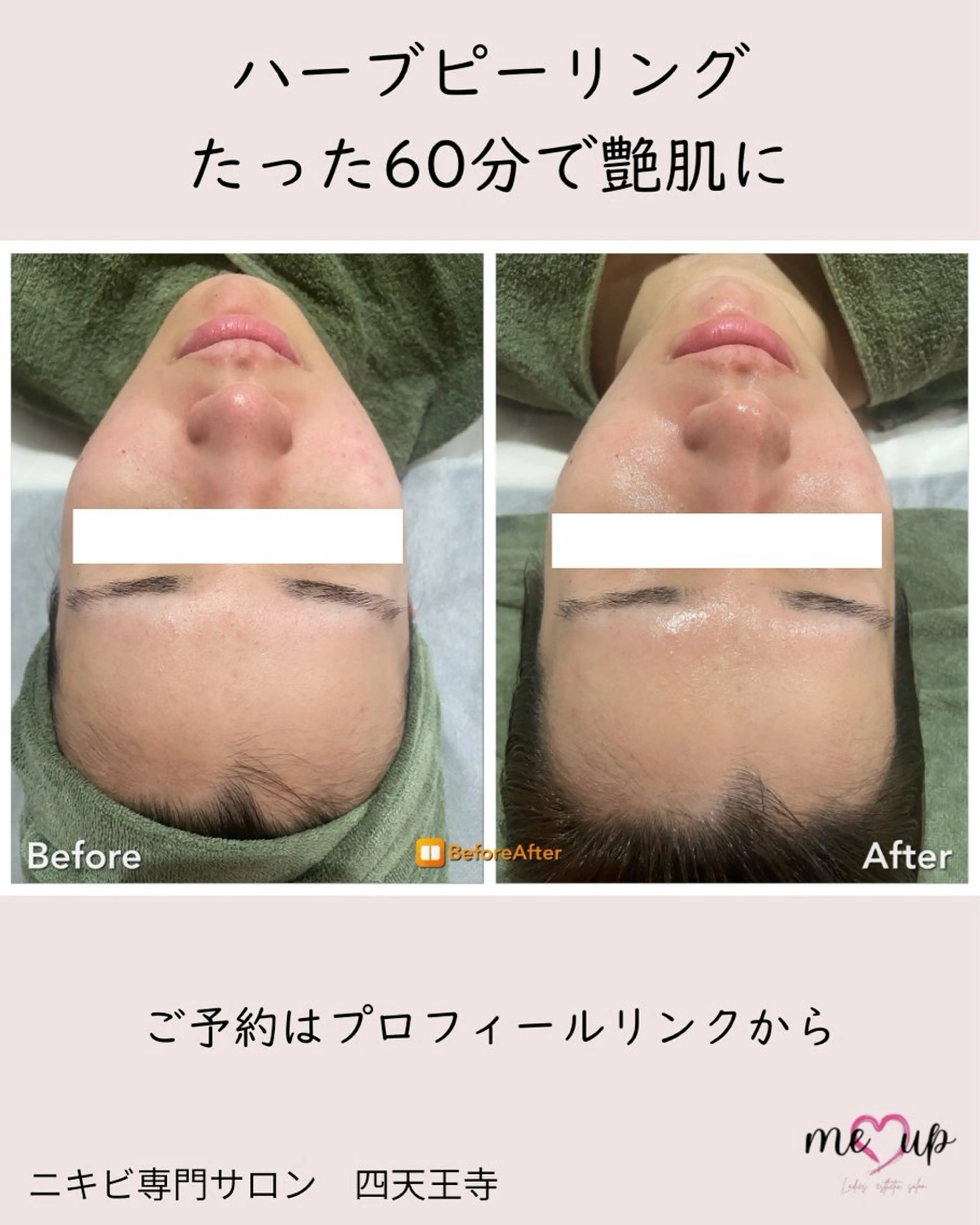 Meupニキビ専門店 背中/ハーブ/肌管理のその他イメージ