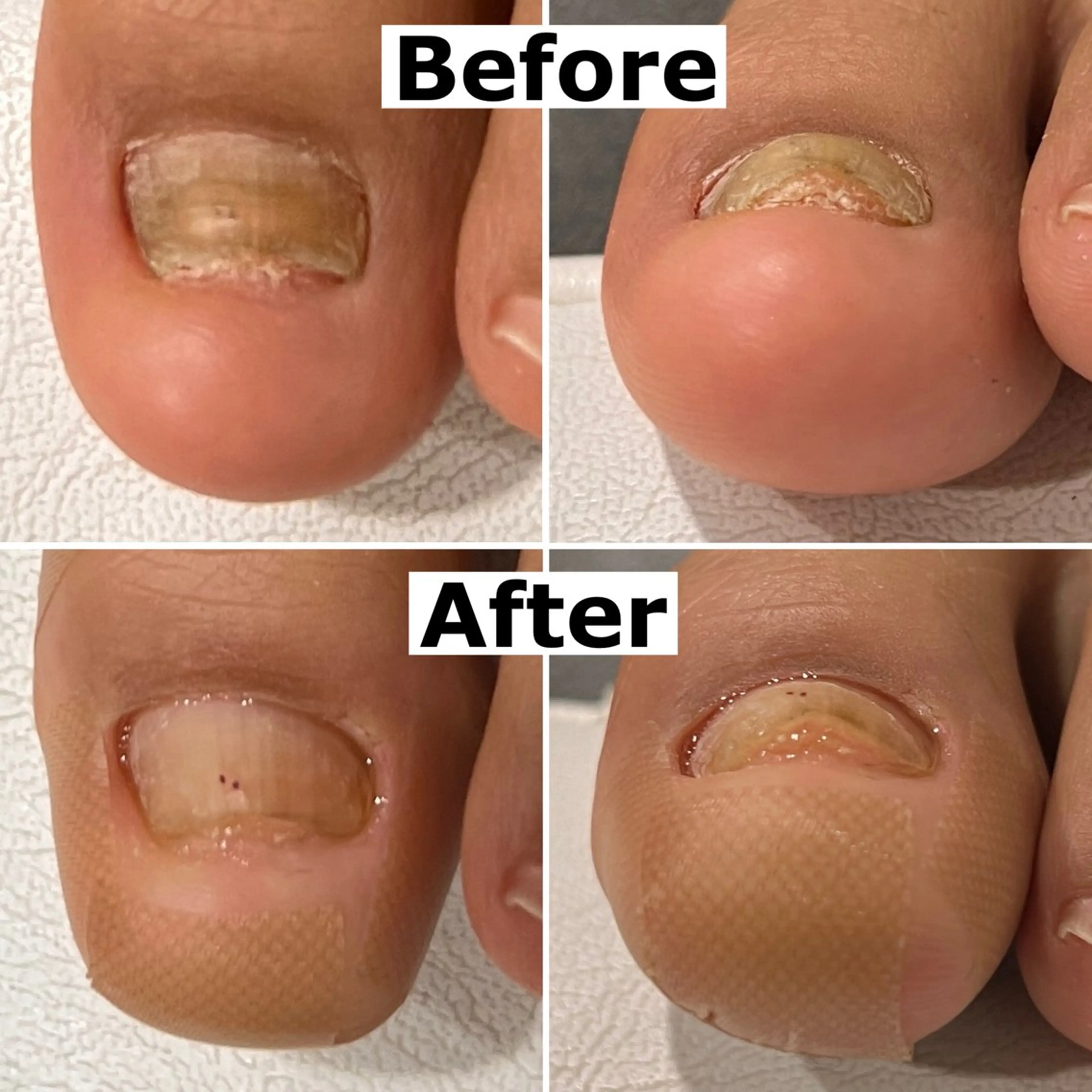 巻爪無料モデル募集 ✨🦶MEGUMIのネイルデザイン