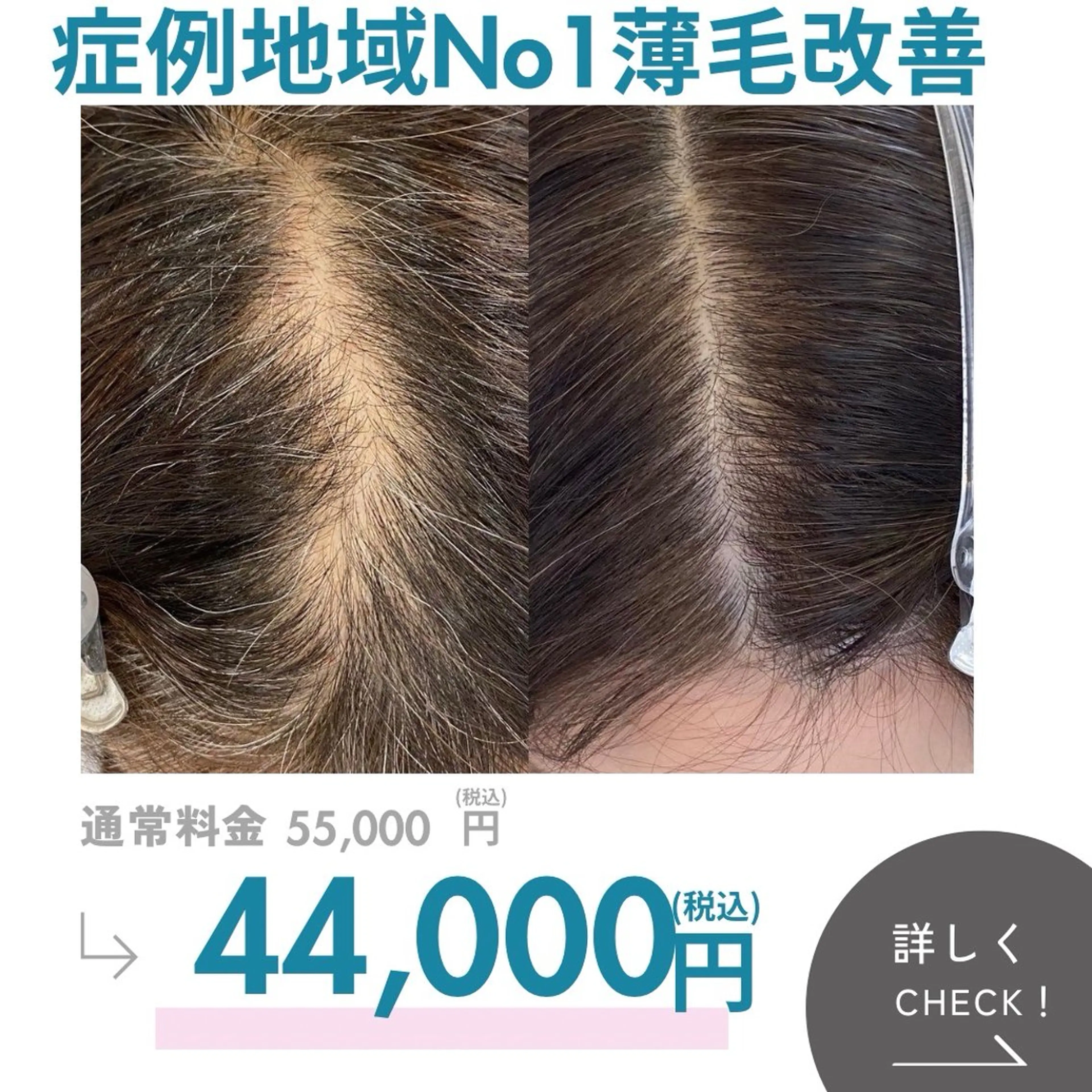 本気の薄毛改善　もう隠さない　頭皮集中改善ケアの写真