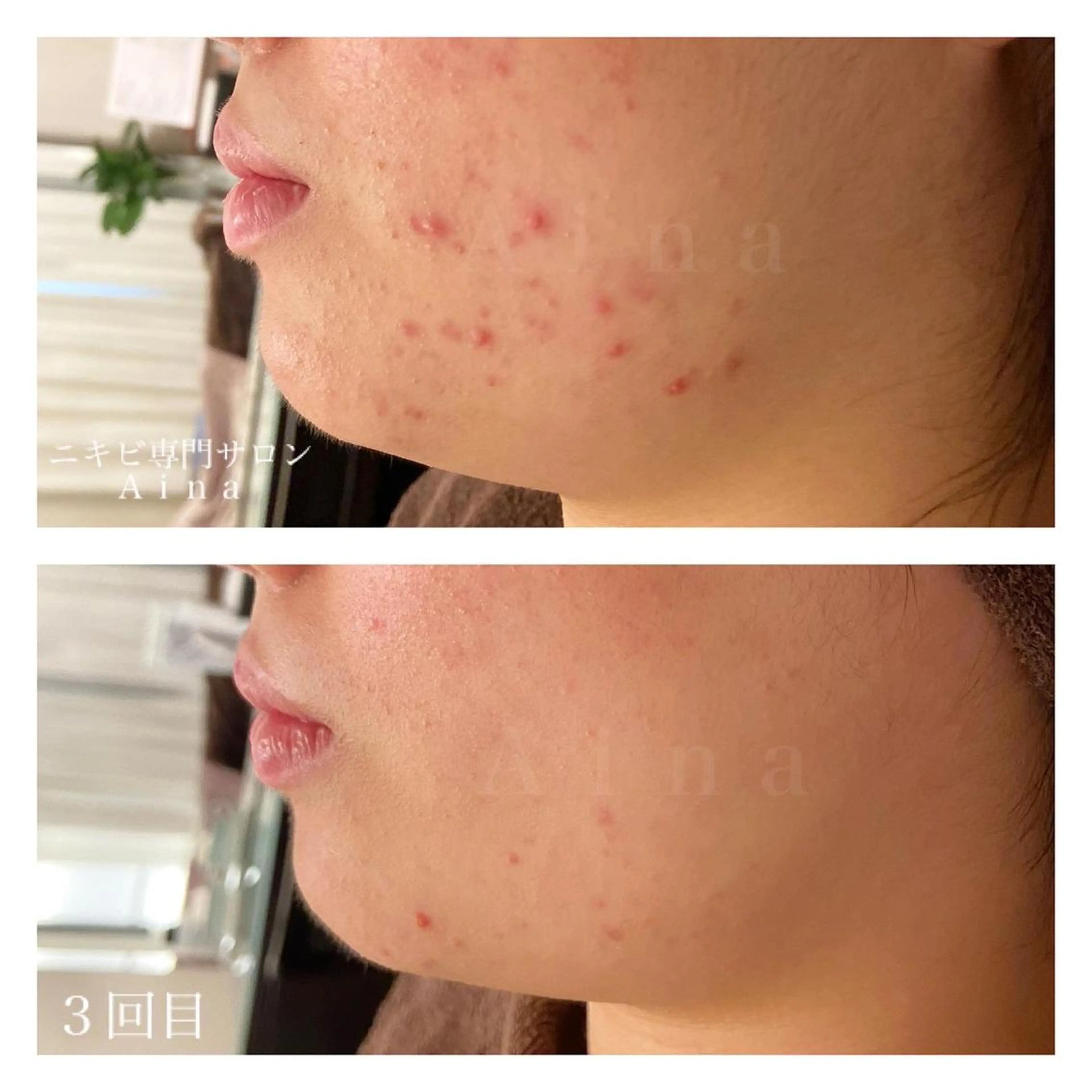 ミディアム カラー パーマ ヘアアレンジ メンズ キッズ マツエク・マツパ エステ リラク ニキビ跡専門サロン Ａｉｎａのエステ・リラクイメージ