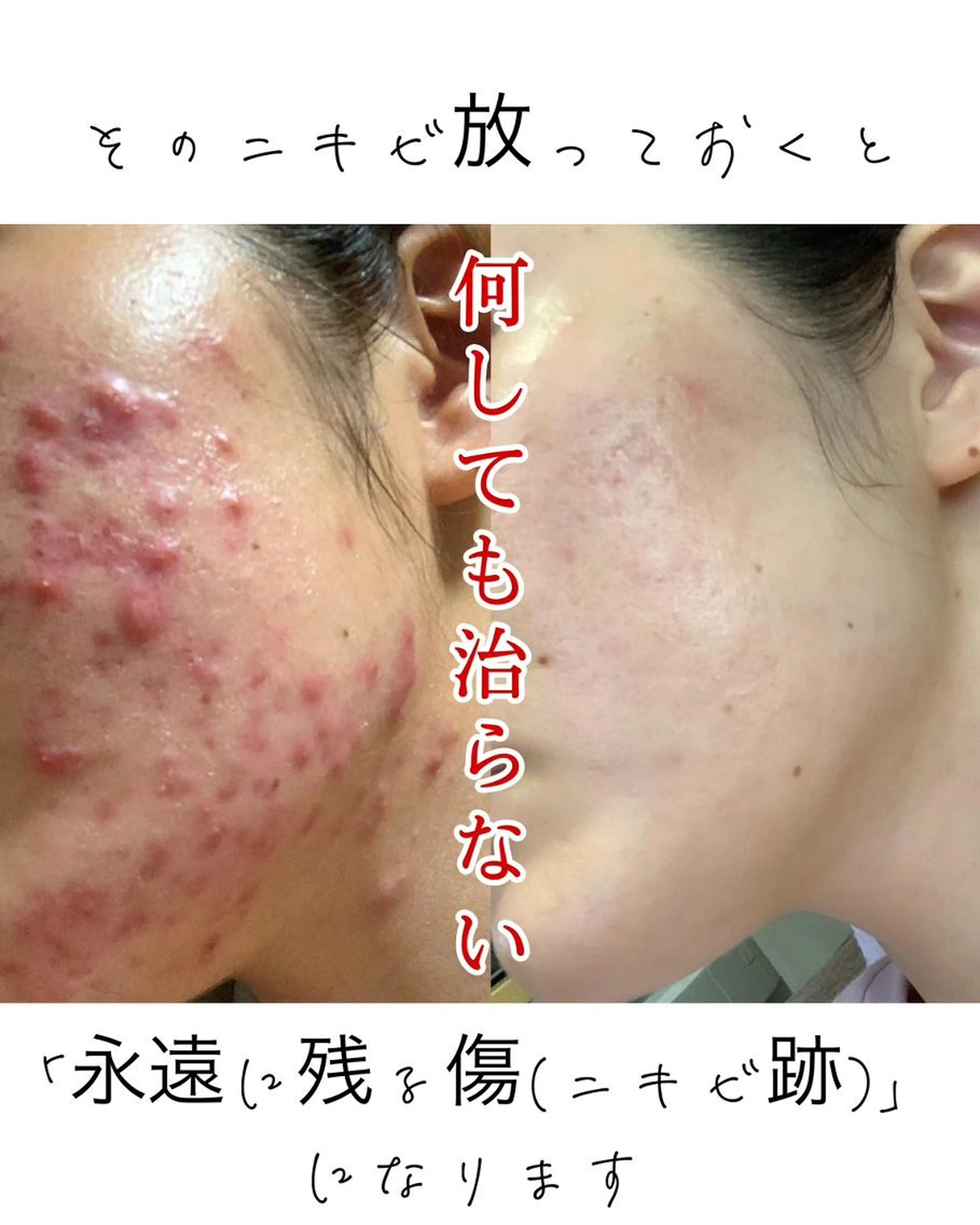 【本気改善】剥離あり水光肌ハーブピーリング 27,500円→8,800円の写真