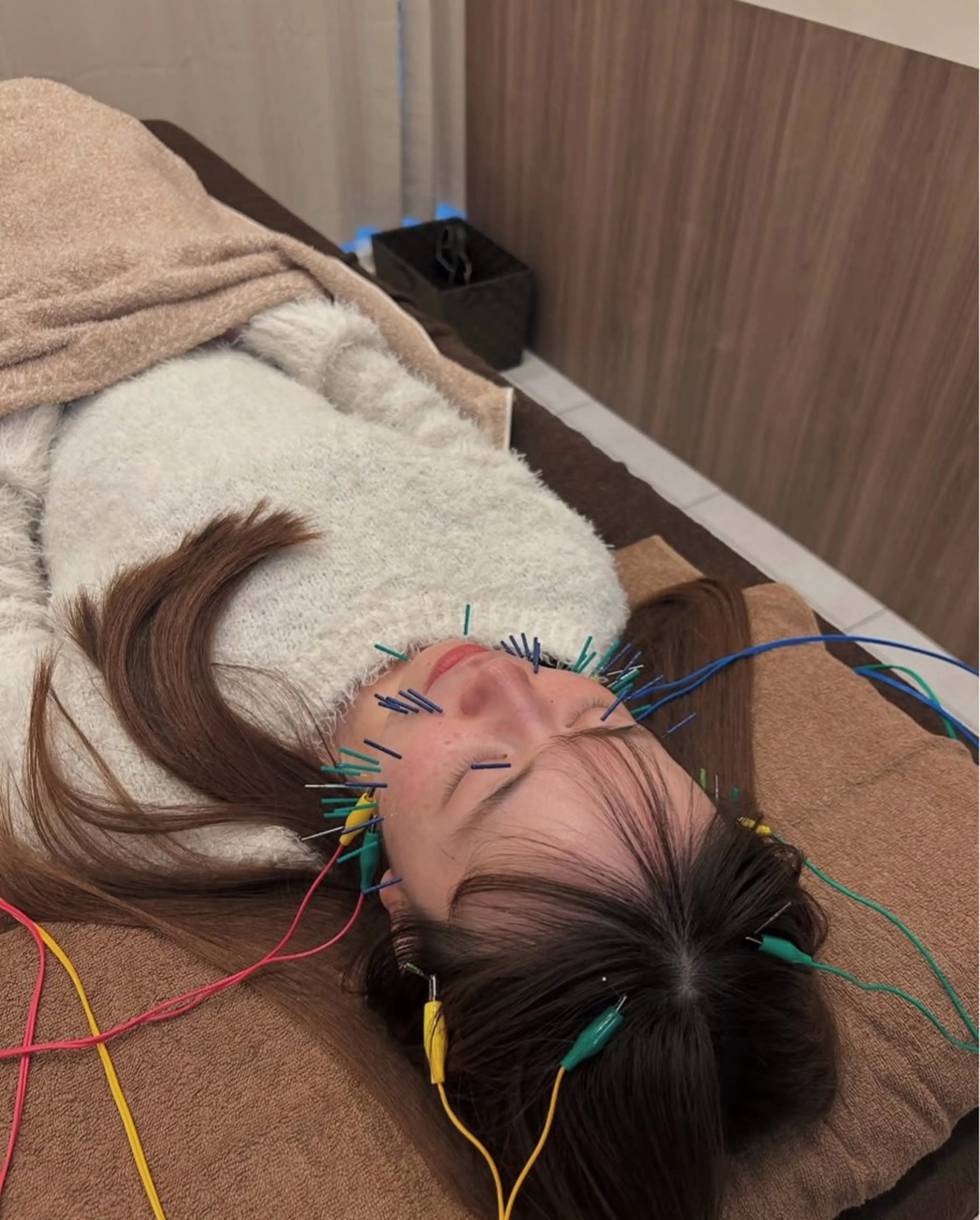 🪡 Special 美容鍼（80本）の写真