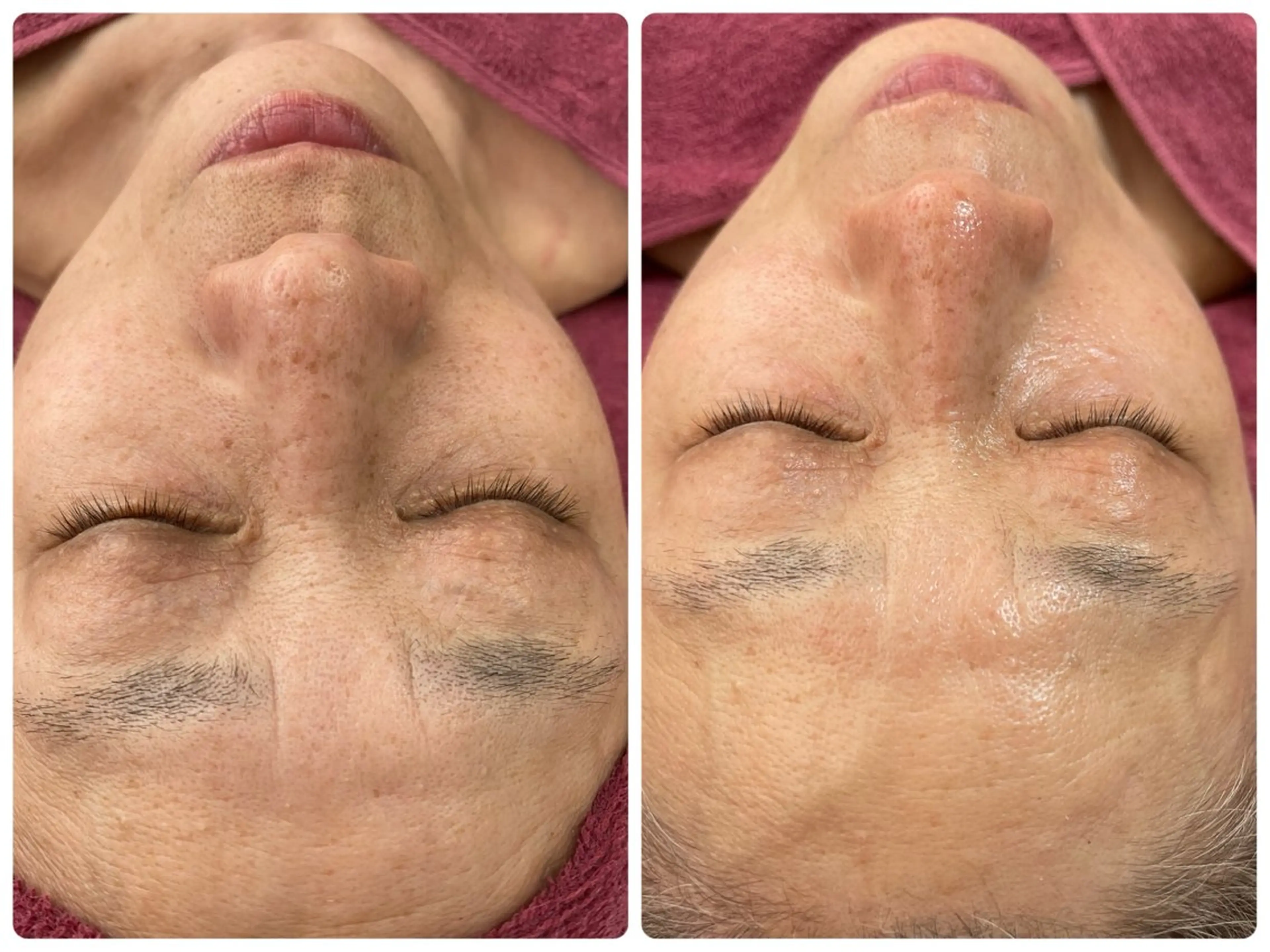 エステ Chalon所属・REVI取扱・肌悩み 毛穴Chalonのエステ・リラクイメージ