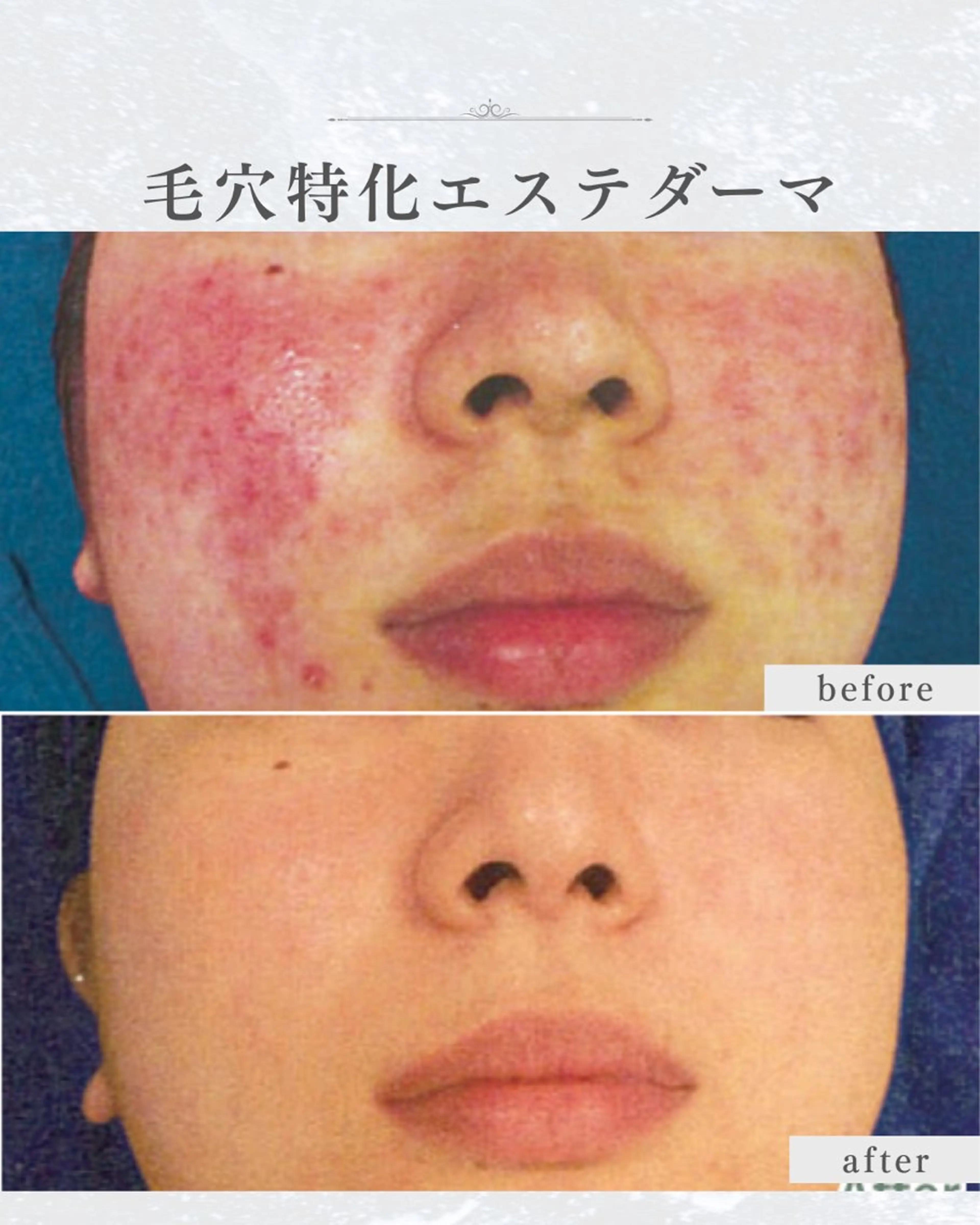 エステ シミ・毛穴ケア専門 クロヌYUKIのエステ・リラクイメージ