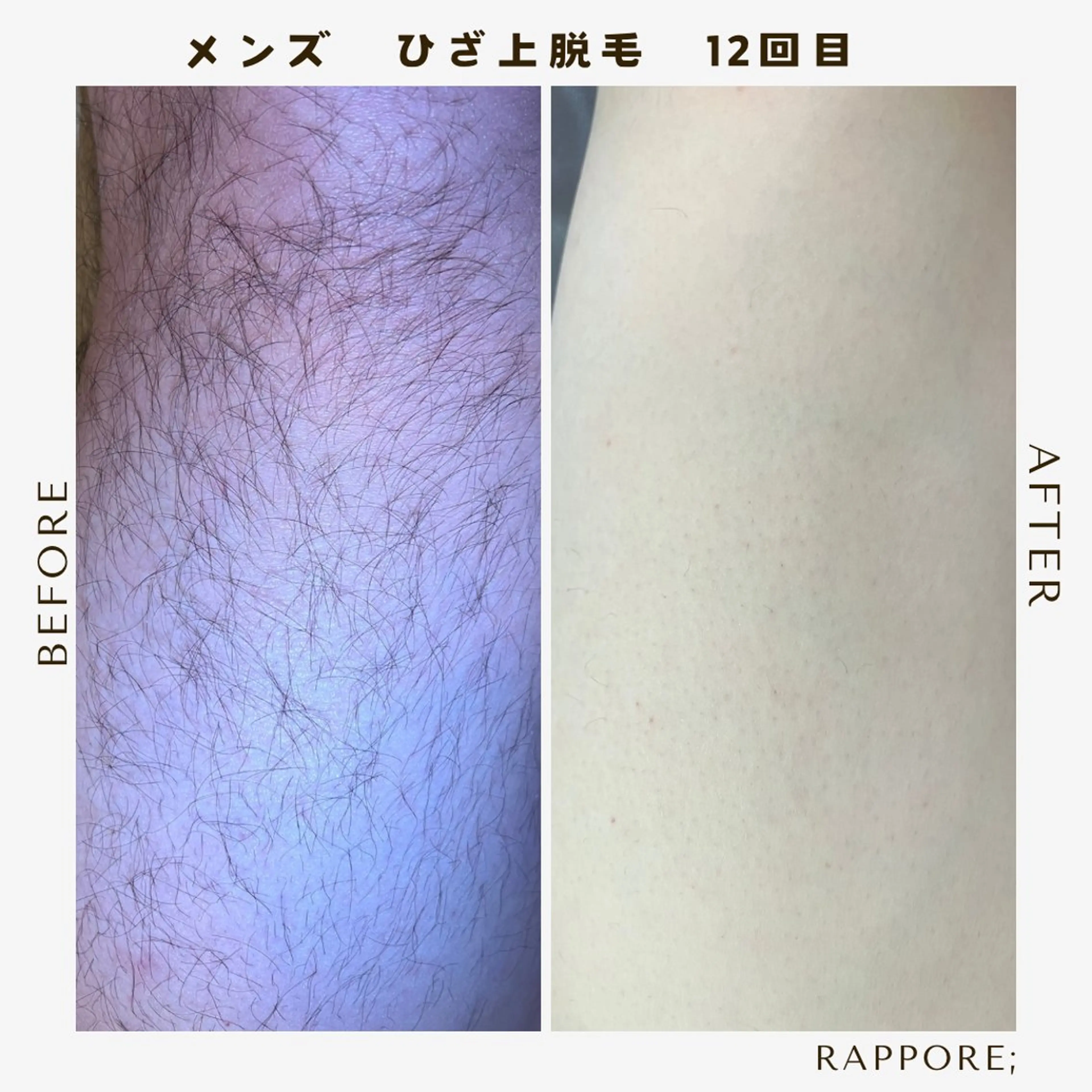 メンズ 脱毛 Rappore; 心斎橋　みずきのエステ・リラクイメージ