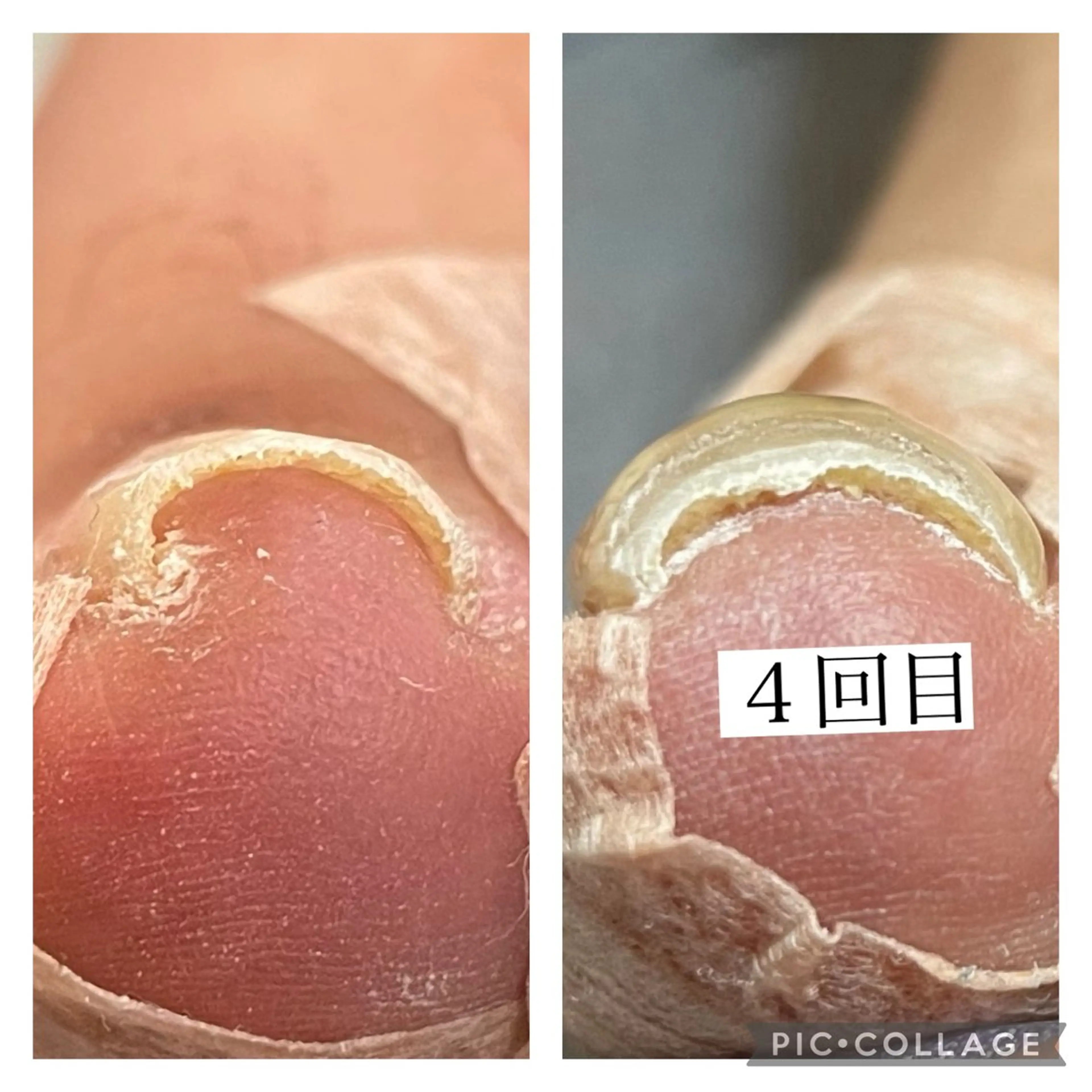 巻き爪ジェル🦶の写真