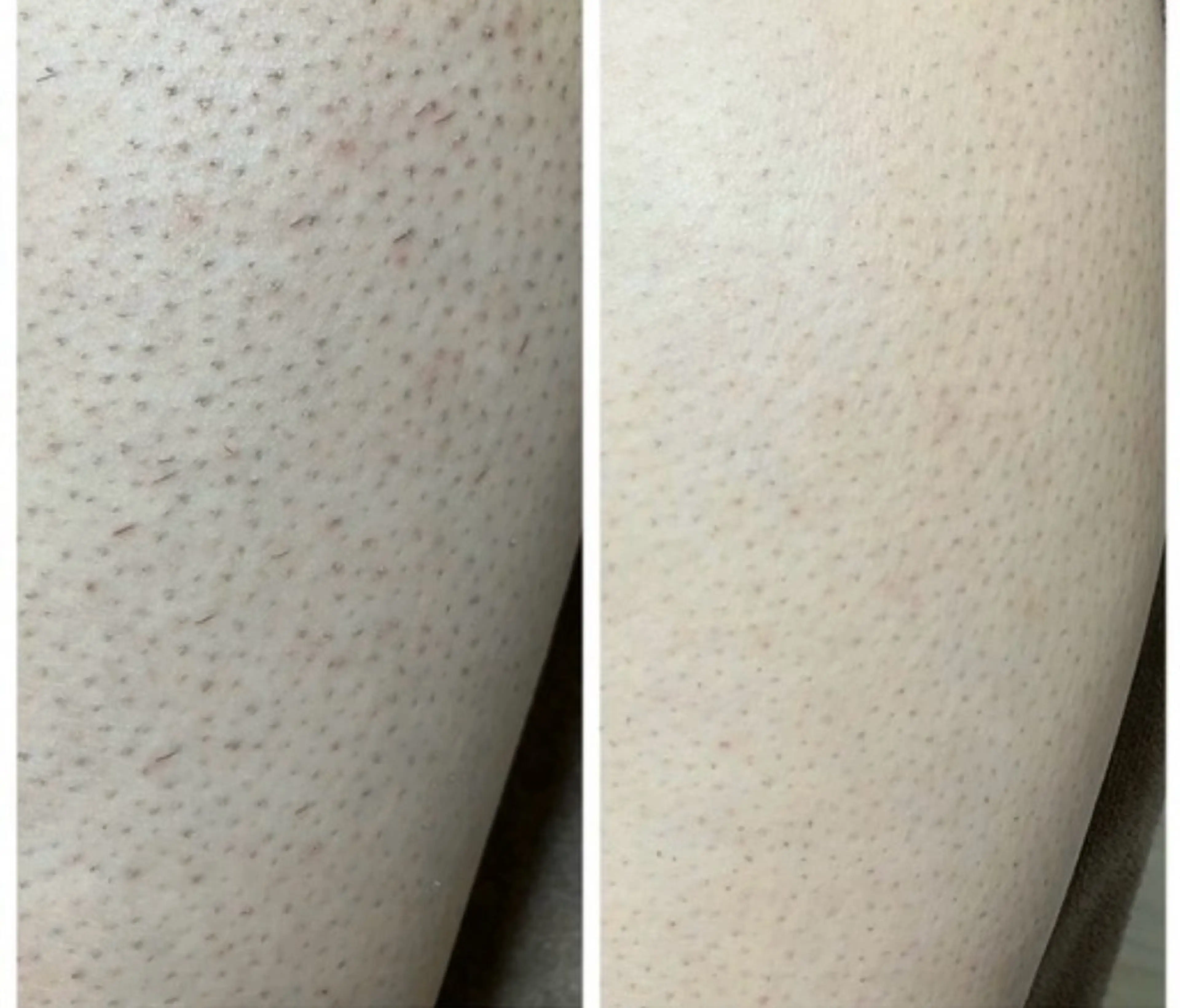 〖脱毛メニュー〗無料カウンセリング  ご予約用の写真