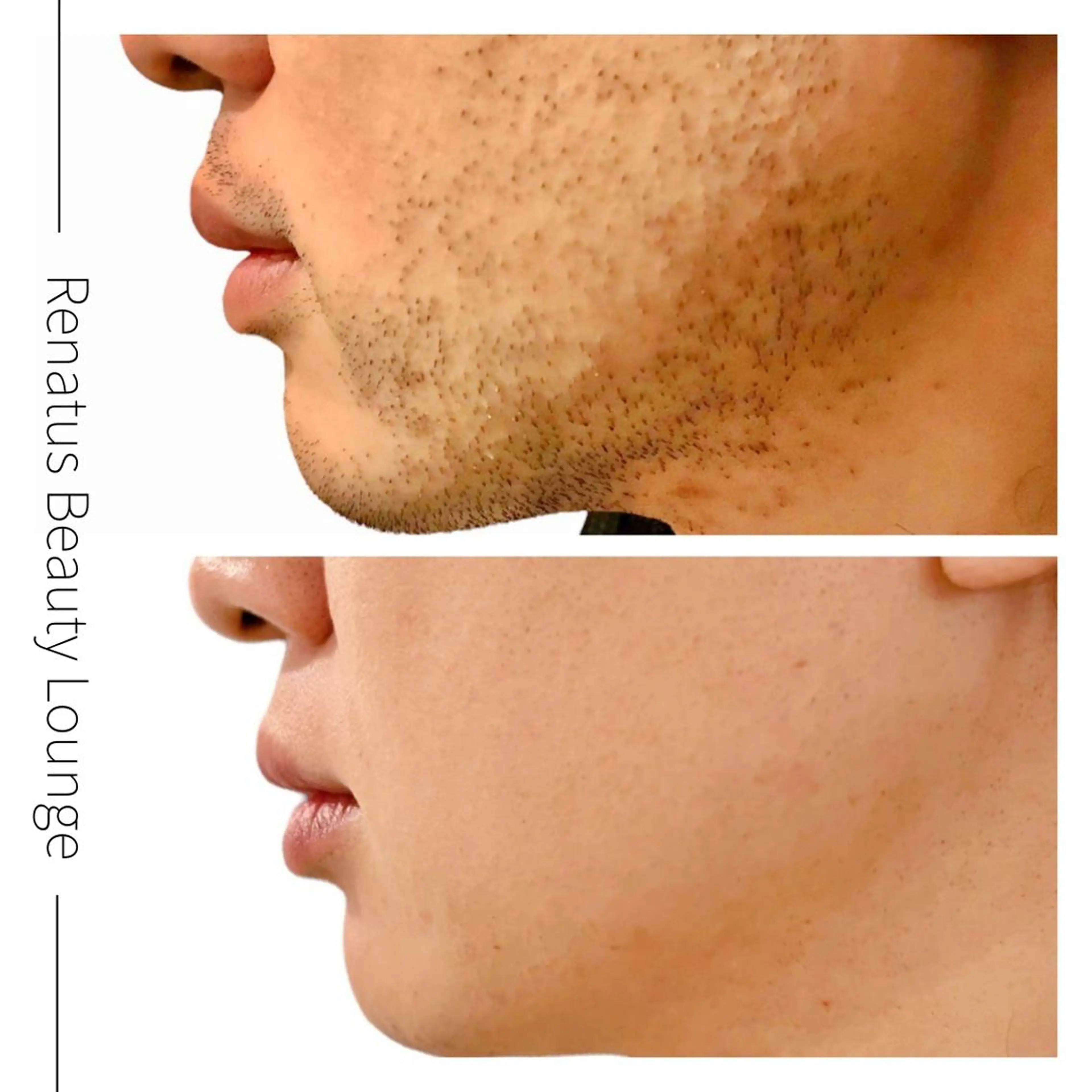 メンズ Renatus 脱毛/美肌/眉/痩身のエステ・リラクイメージ