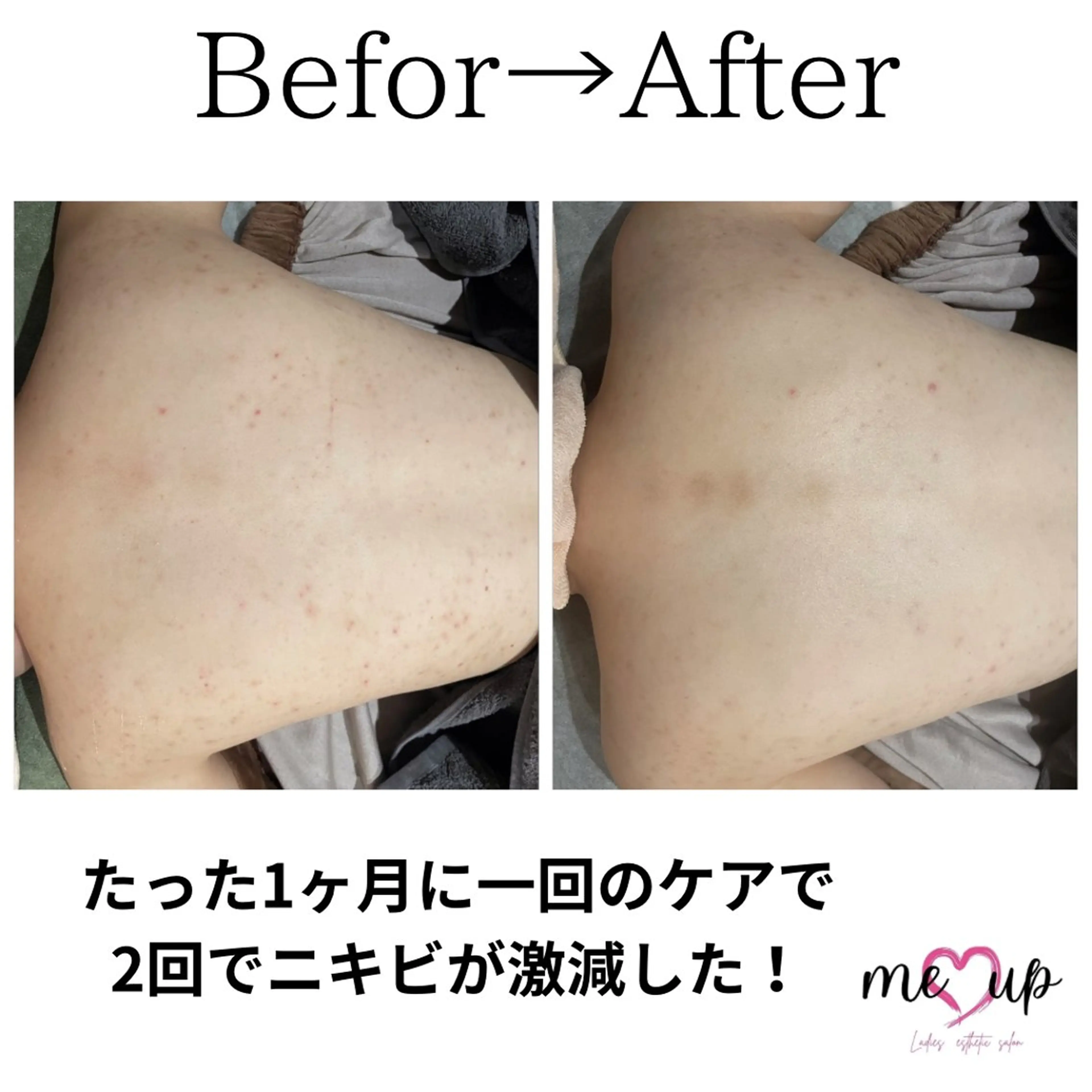 エステ Meupニキビ専門店 背中/ハーブ/肌管理のその他イメージ