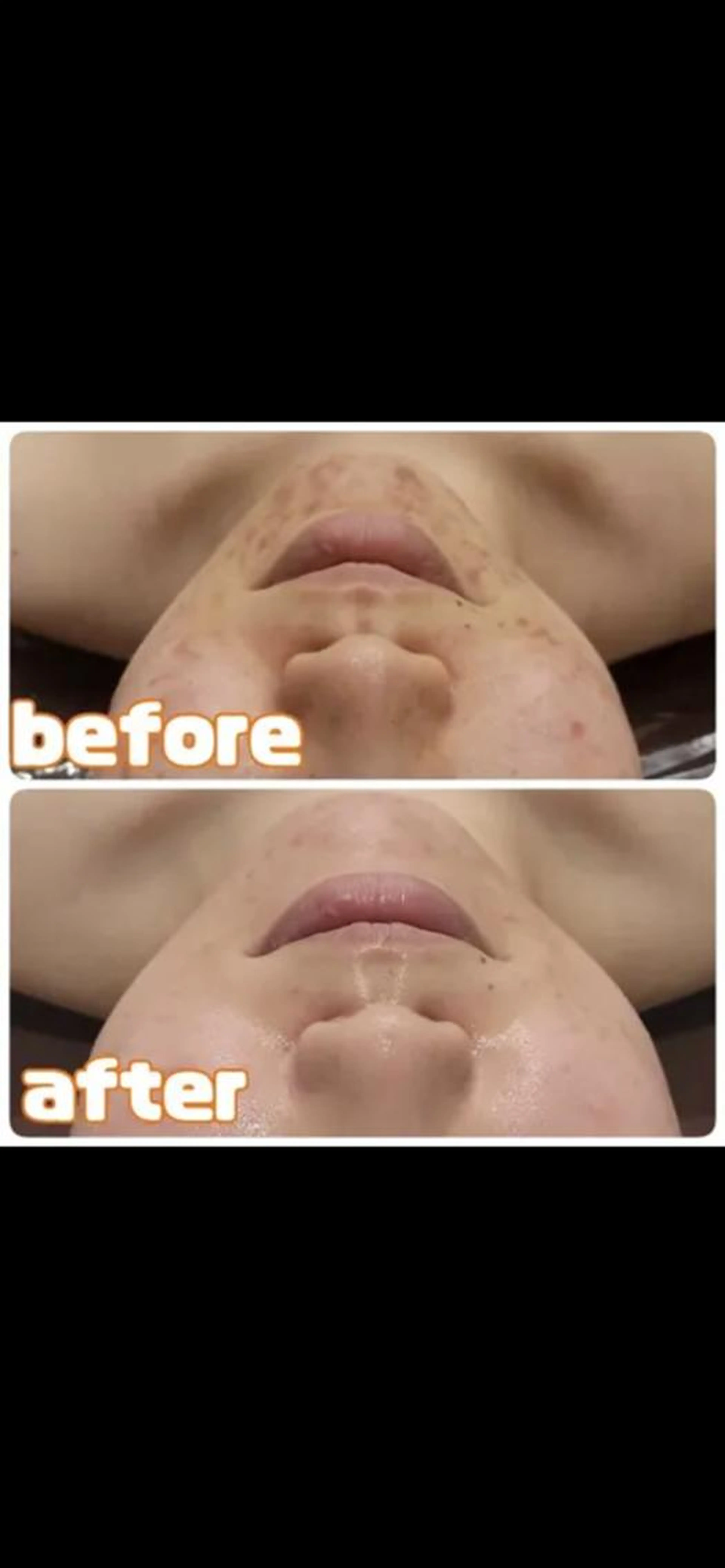 🍓🍷脱毛とフェイシャルのいいとこ取り🍓🍷ピーリング&パック付き❤韓国肌・美白・毛穴・小顔・化粧ノリUP🍓🍷の写真