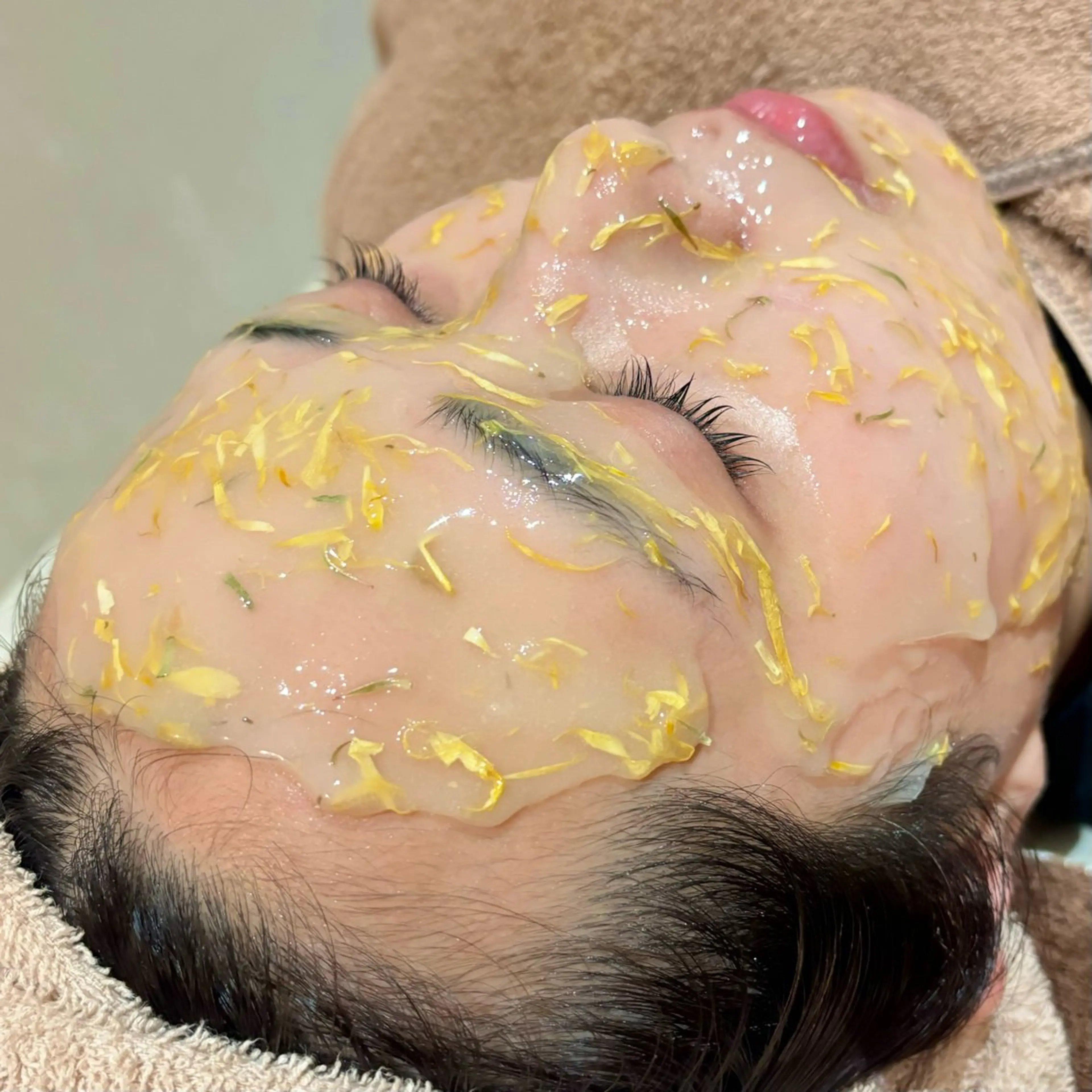 【ミニモ限定価格★ニキビ/跡】針を使わない美容液導入☆赤み鎮静ケアの写真