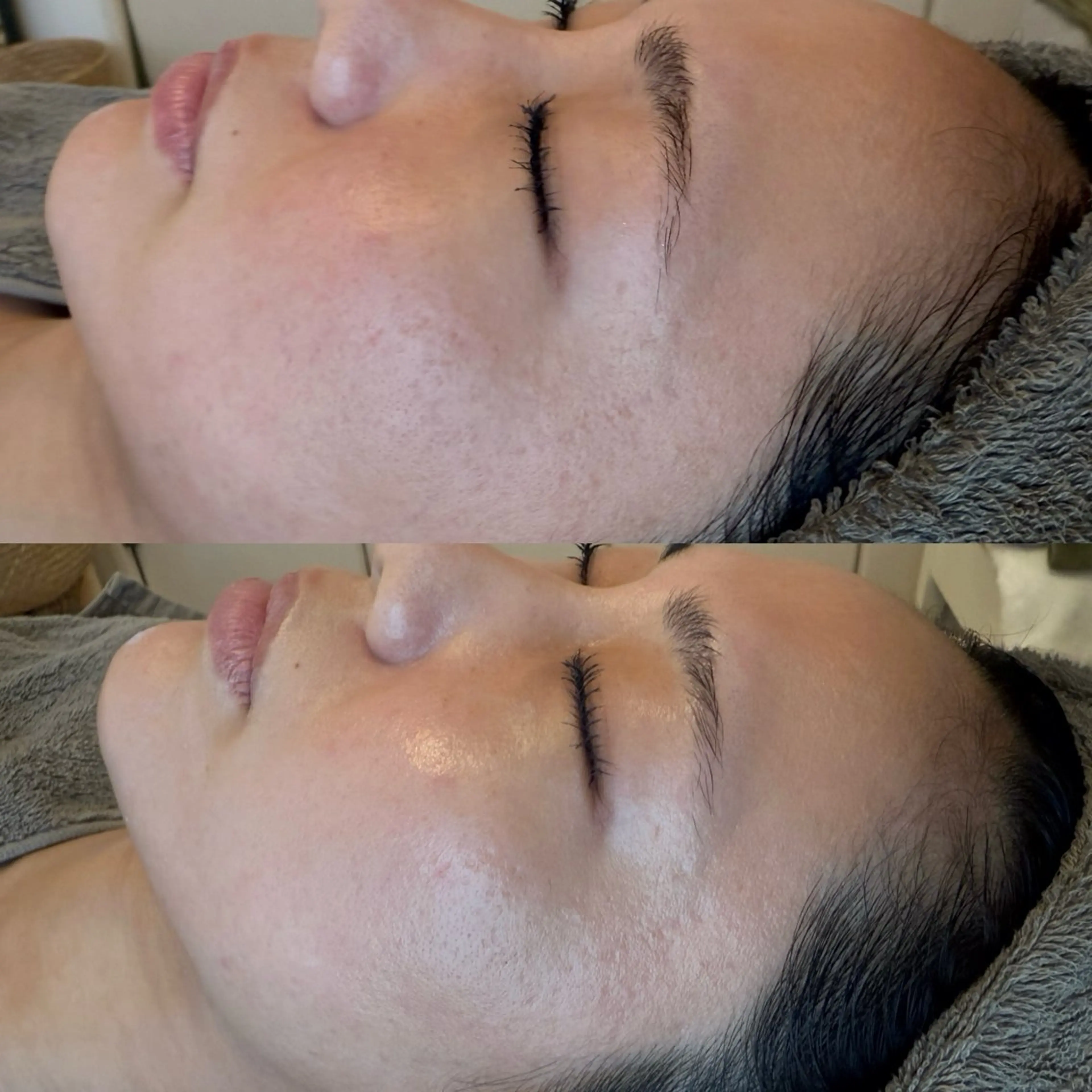 エステ リラク ニキビ・毛穴改善 🌿ハーブピーリングのエステ・リラクイメージ