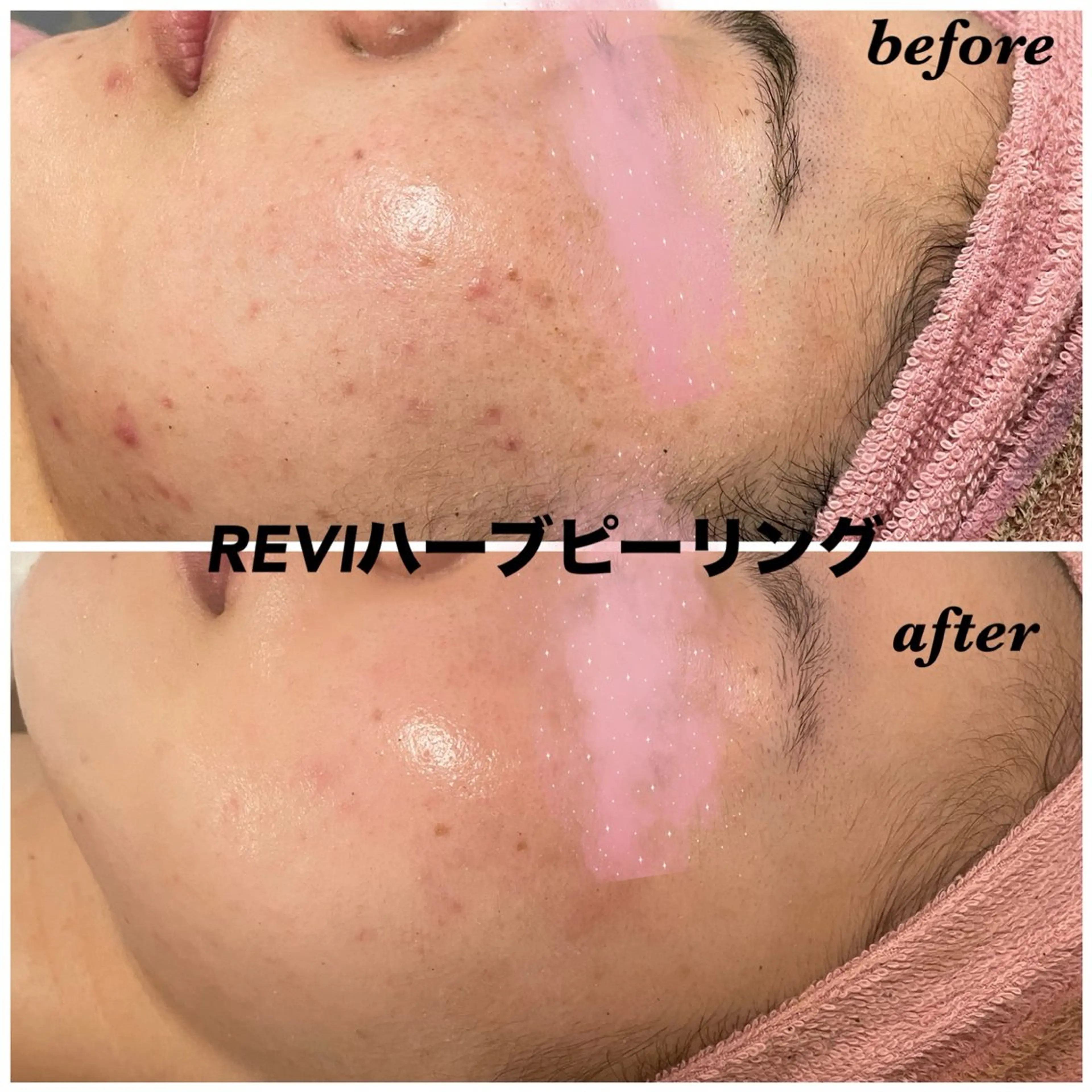 エステ ハーブピーリング専門 毛穴洗浄❤️眉waxのエステ・リラクイメージ