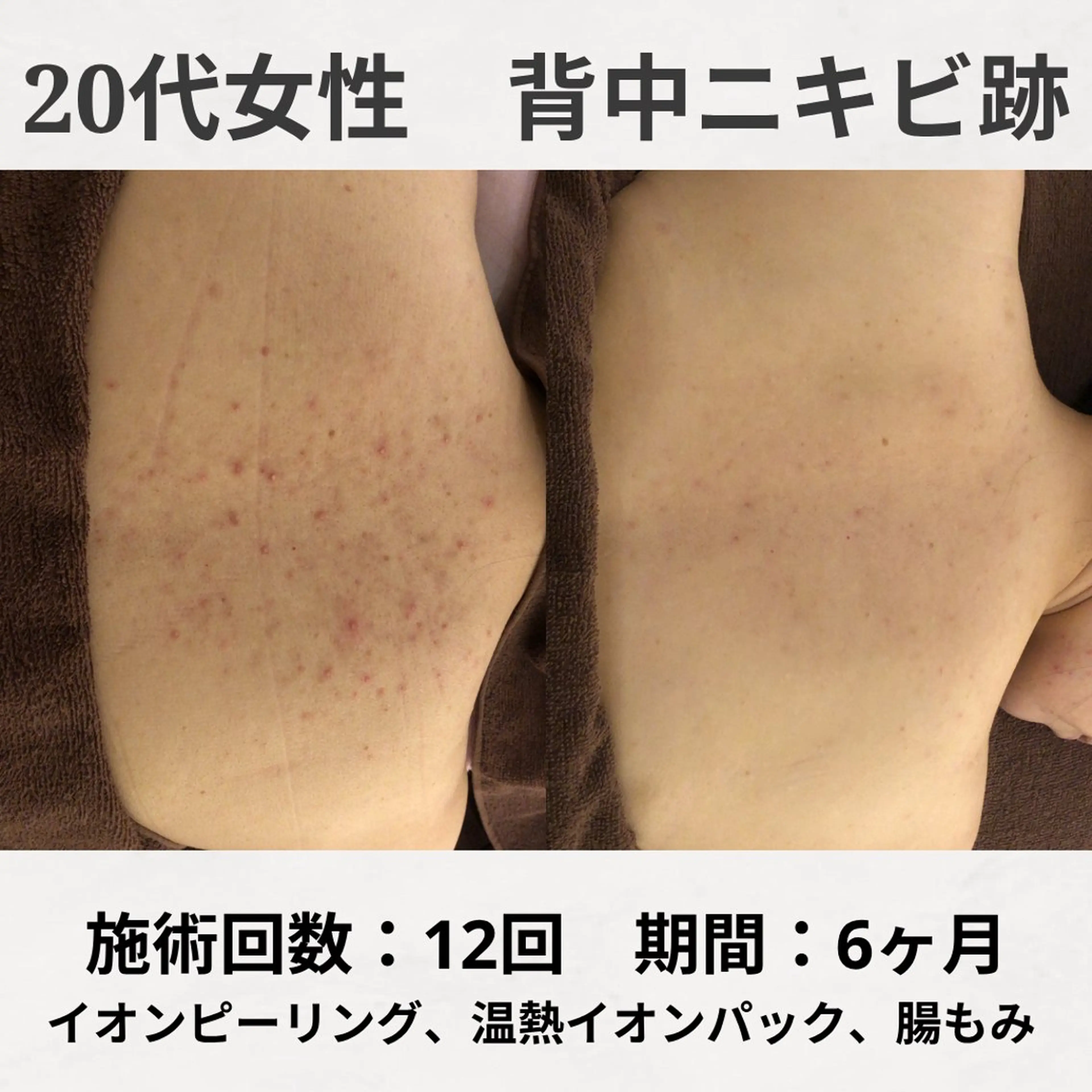 エステ リラク ニキビ跡改善専門🔥 医療にはできない改善のエステ・リラクイメージ