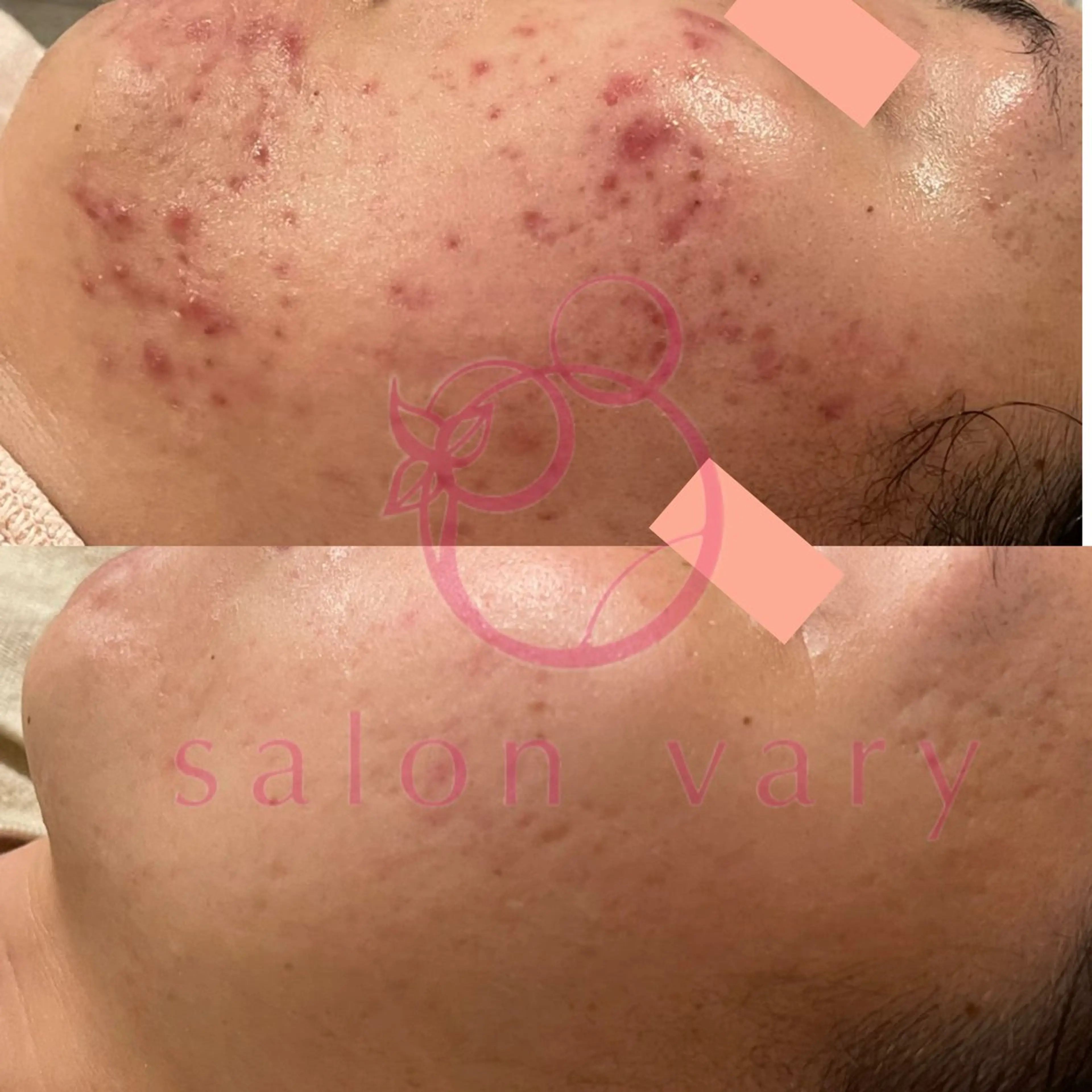 【ニキビ/肌管理】 salon varyのエステ・リラクイメージ