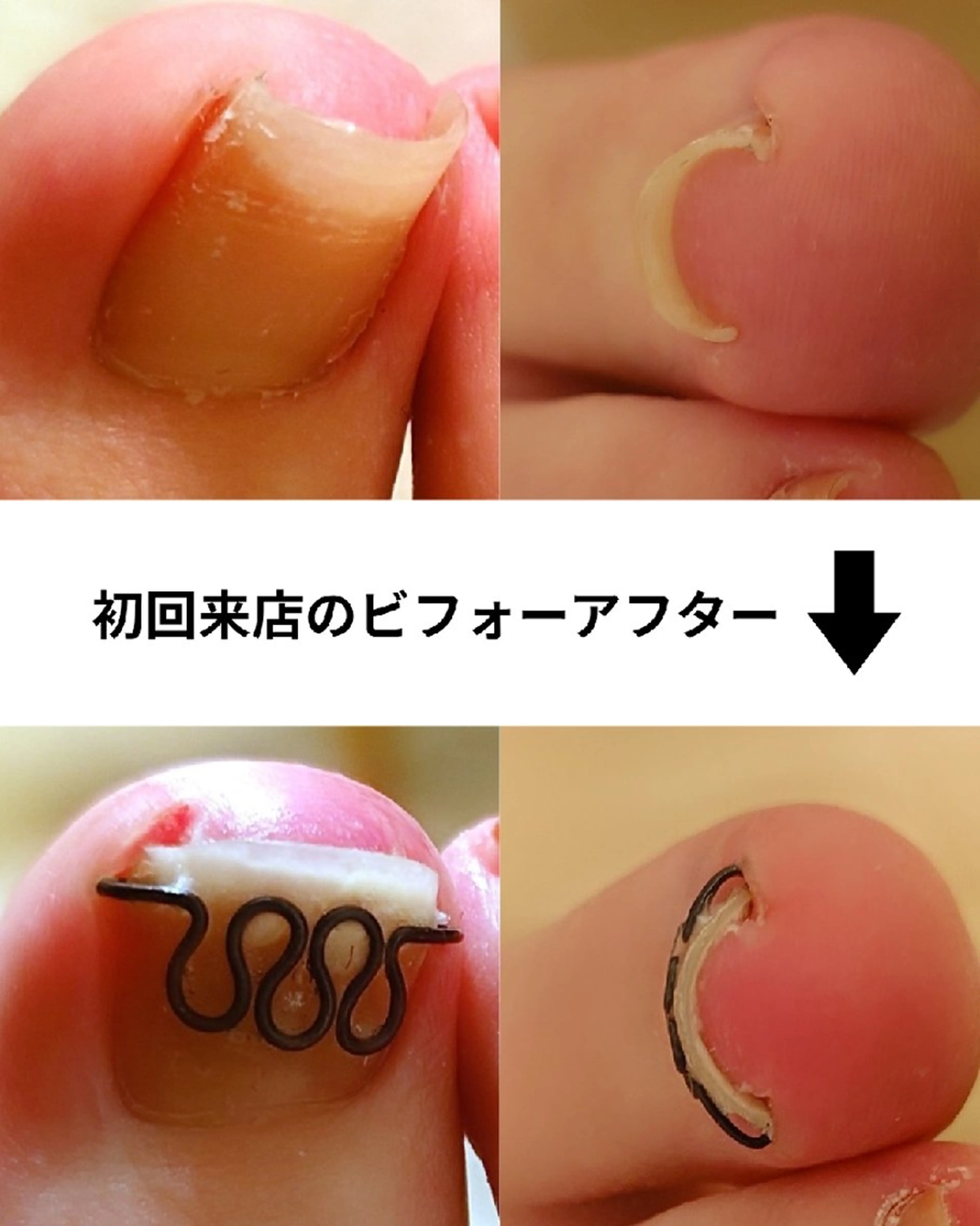 【ツメフラ法巻爪矯正】痛みや見た目が気にならない育爪✨巻爪矯正15400円→8800円！の写真