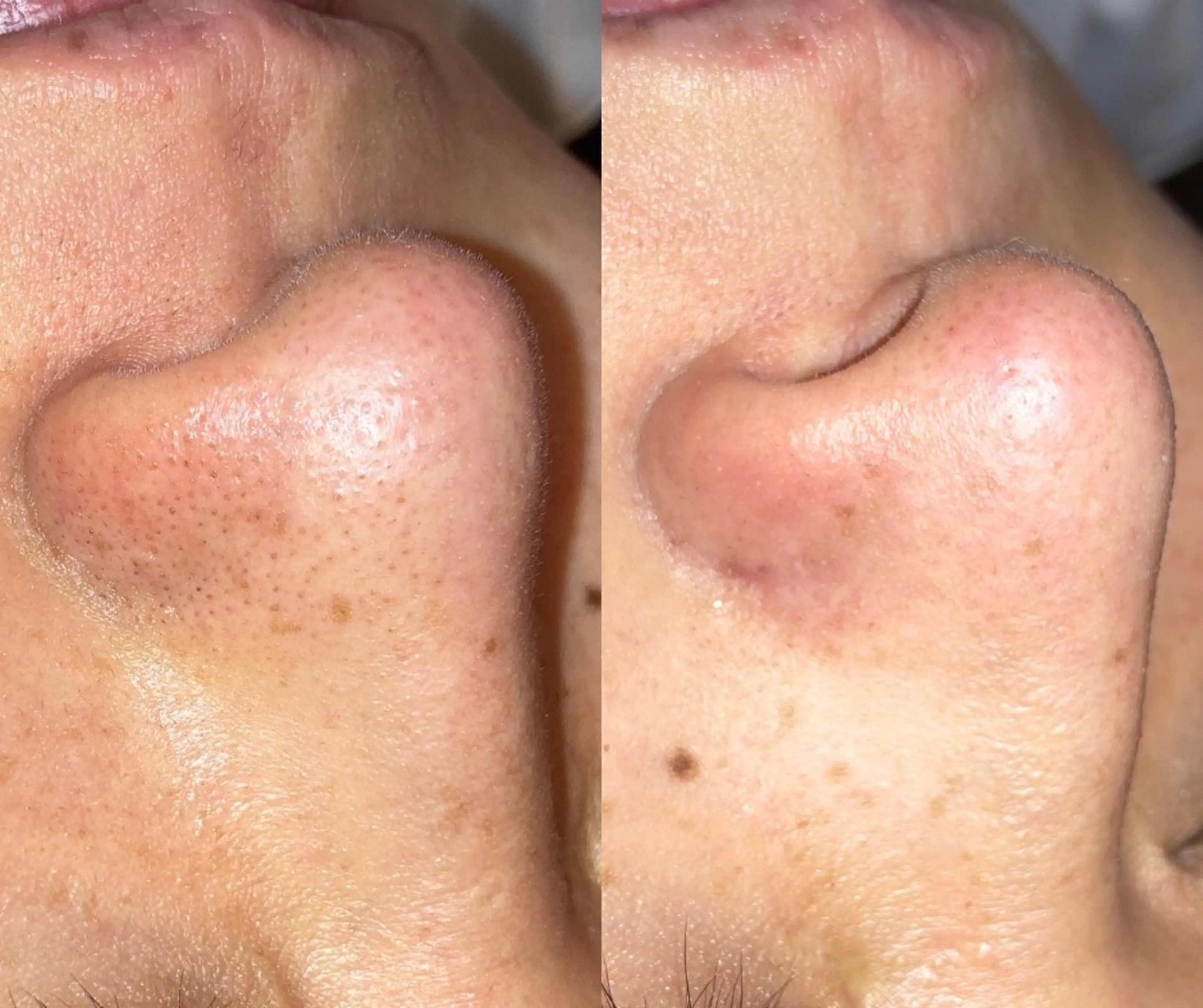 【毛穴詰まり/黒ずみ/開き】韓国式ハイドラ毛穴洗浄＋高保湿パック導入の写真