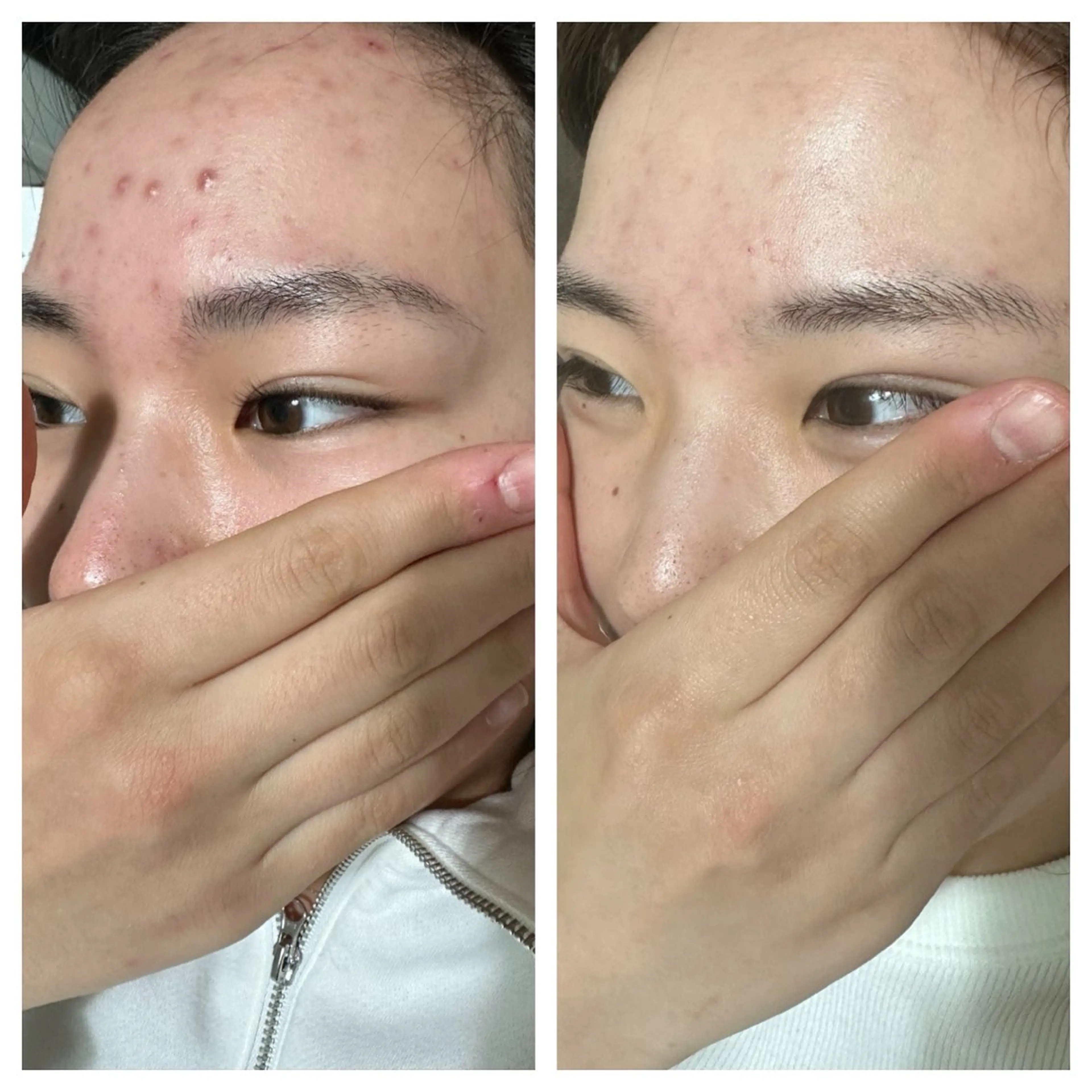 春の肌改善🌿都内最安値ミニモセール限定ツルスベ肌★ハーブピーリングで垢抜け(毛穴/テカリ/ニキビ/肌荒れ/乾燥)の写真