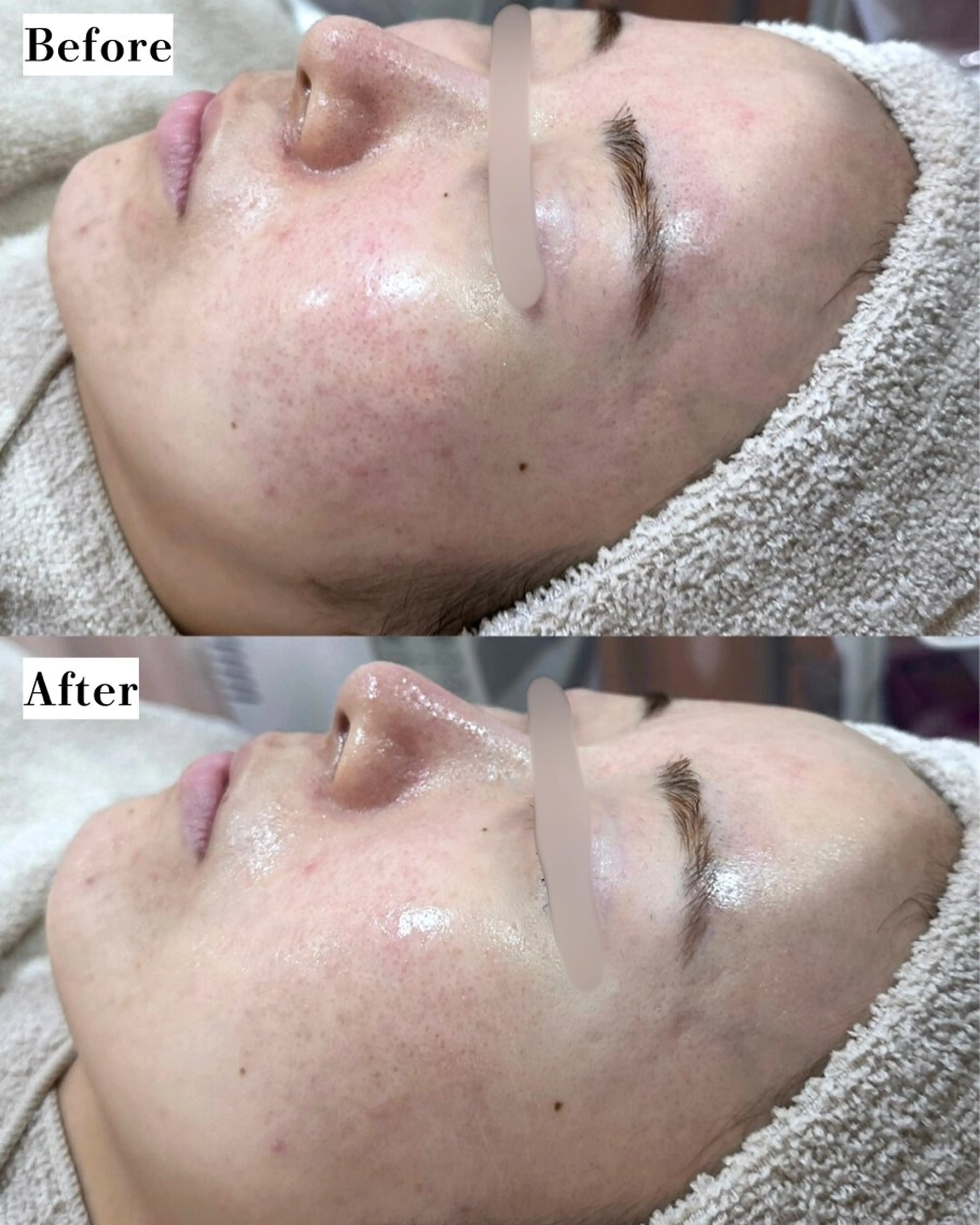 |ピーリング・毛穴| soina神楽坂のエステ・リラクイメージ