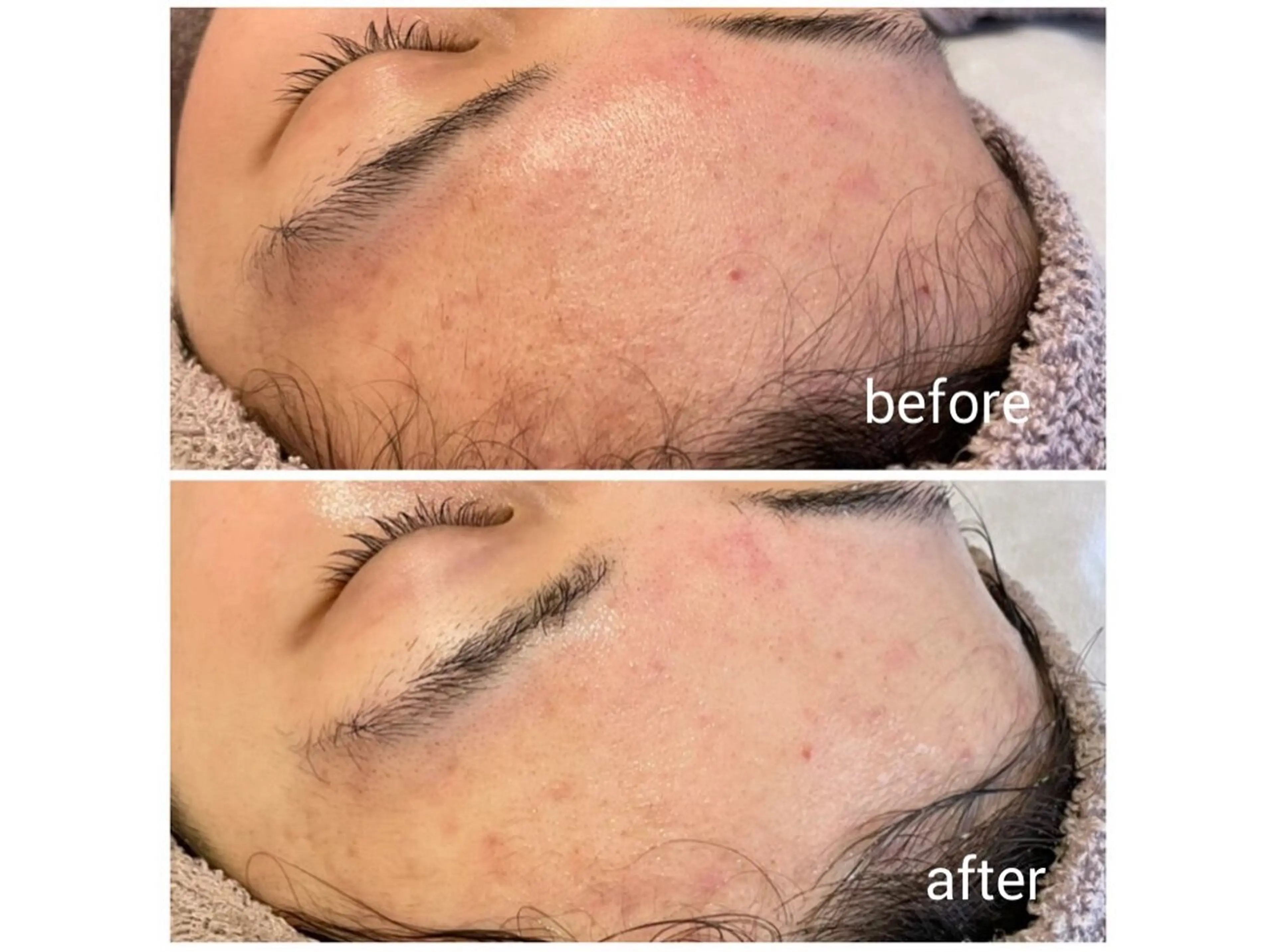 【メンズ限定】ハーブピーリングヘッドマッサージ付き《ハーブ1g(¥5500分)プレゼント》の写真