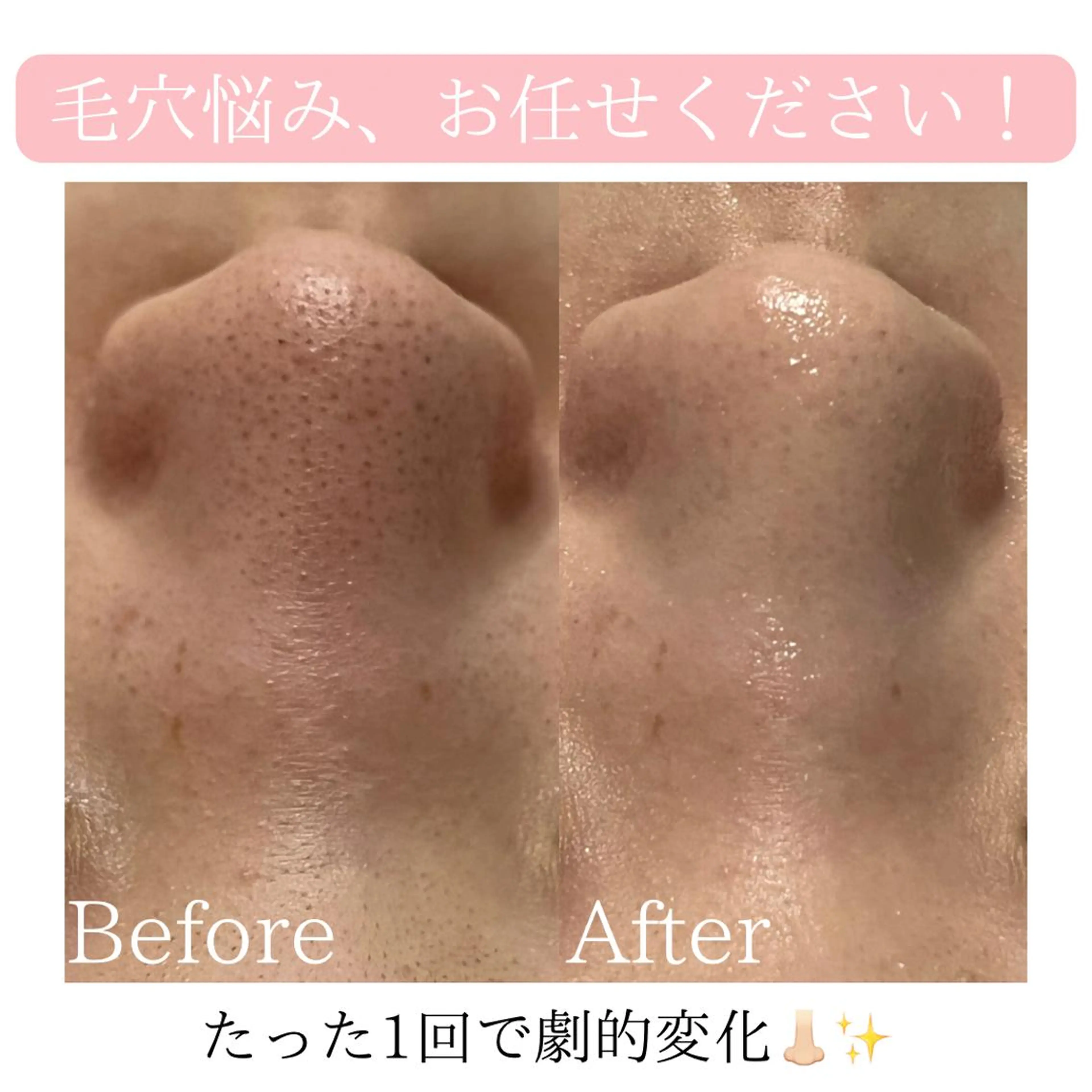 【本日13日1名様限定】即日実感✨全顔ハイドラフェイシャル毛穴洗浄×美容液で毛穴レス肌へ【黒ずみ・詰まり毛穴に】の写真