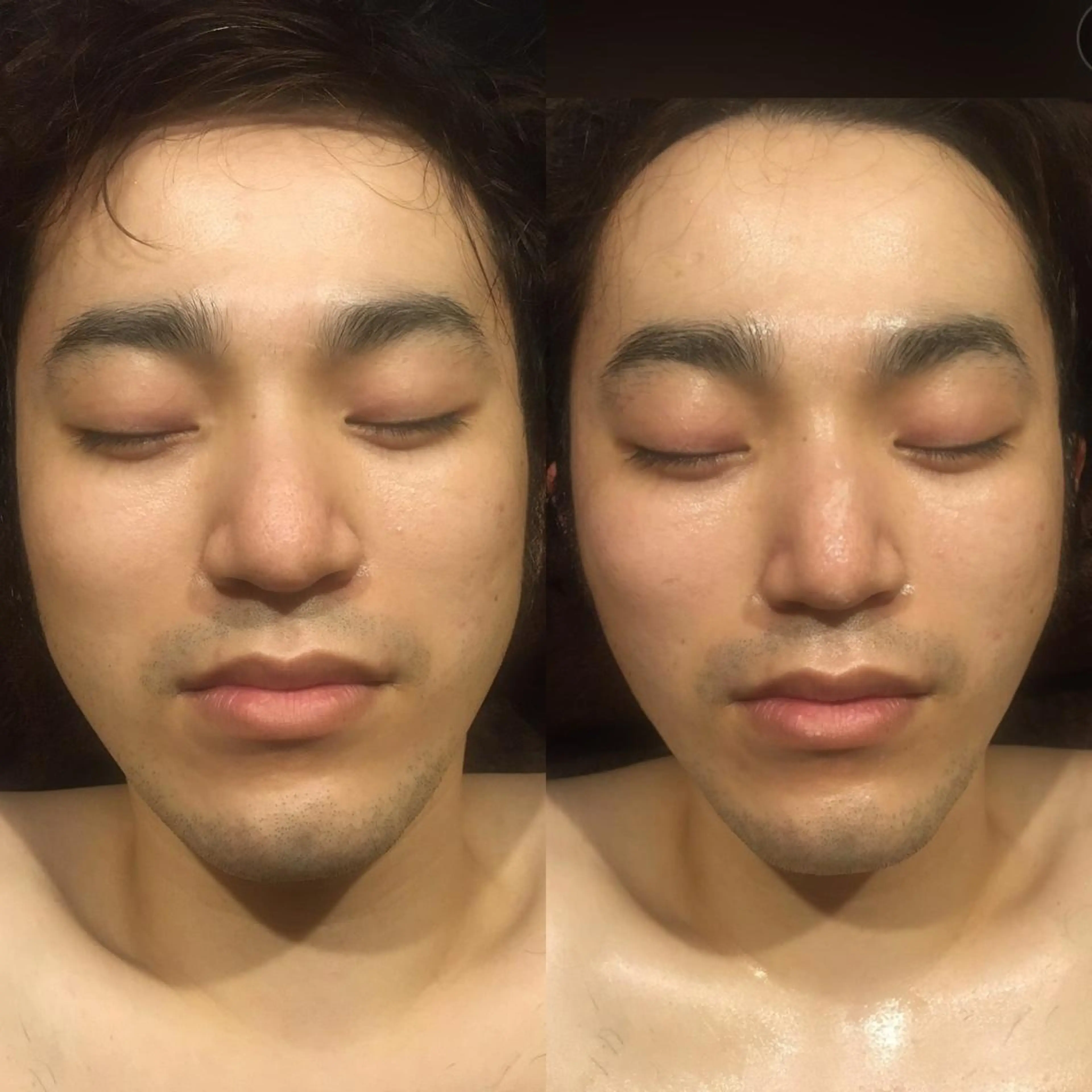 【小顔】当店人気No.1痩身🏅サーモシェイプDeepでお顔スッキリ✨の写真