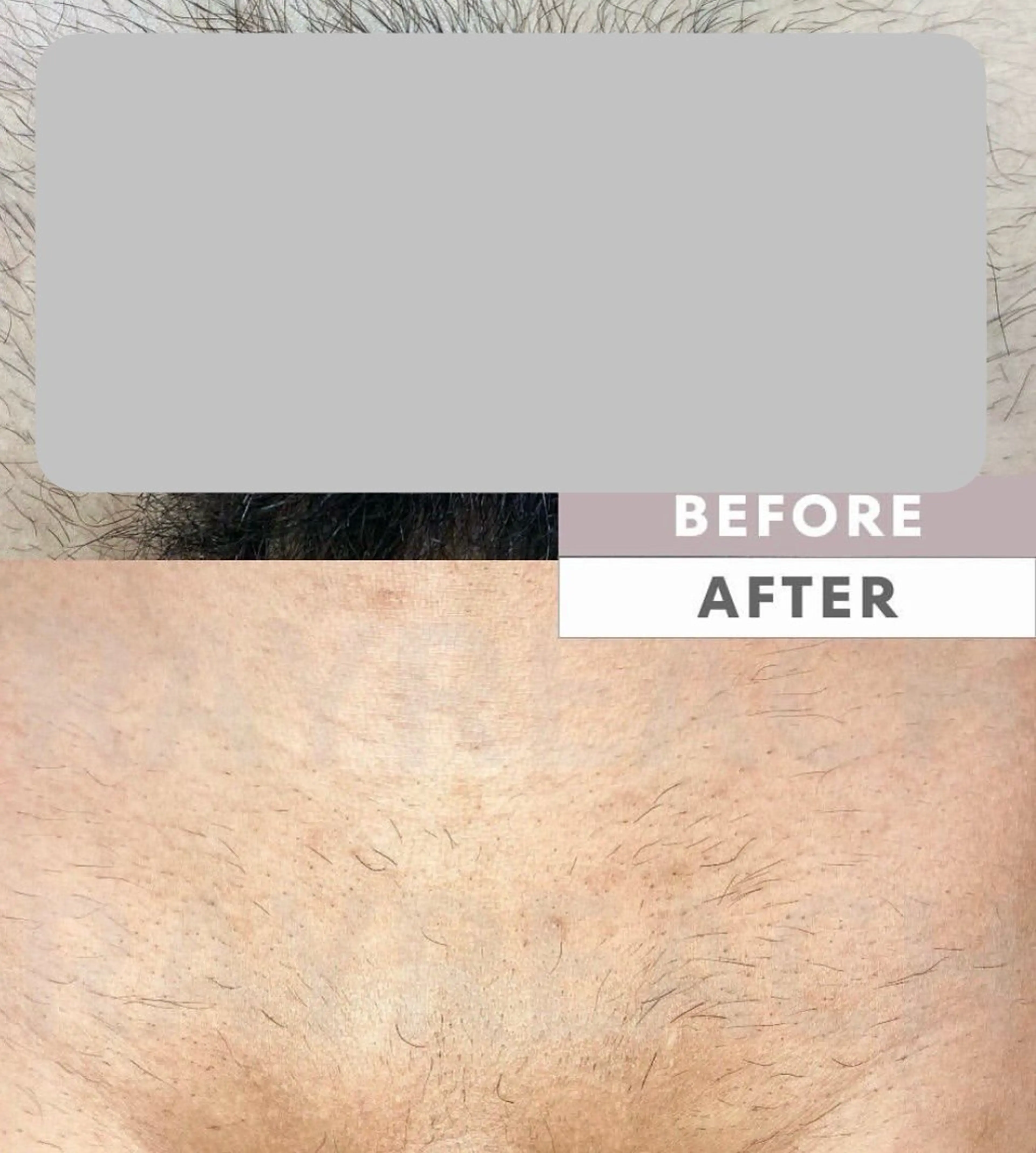 ［仙台メンズ脱毛］  初回　　　VIO脱毛の写真