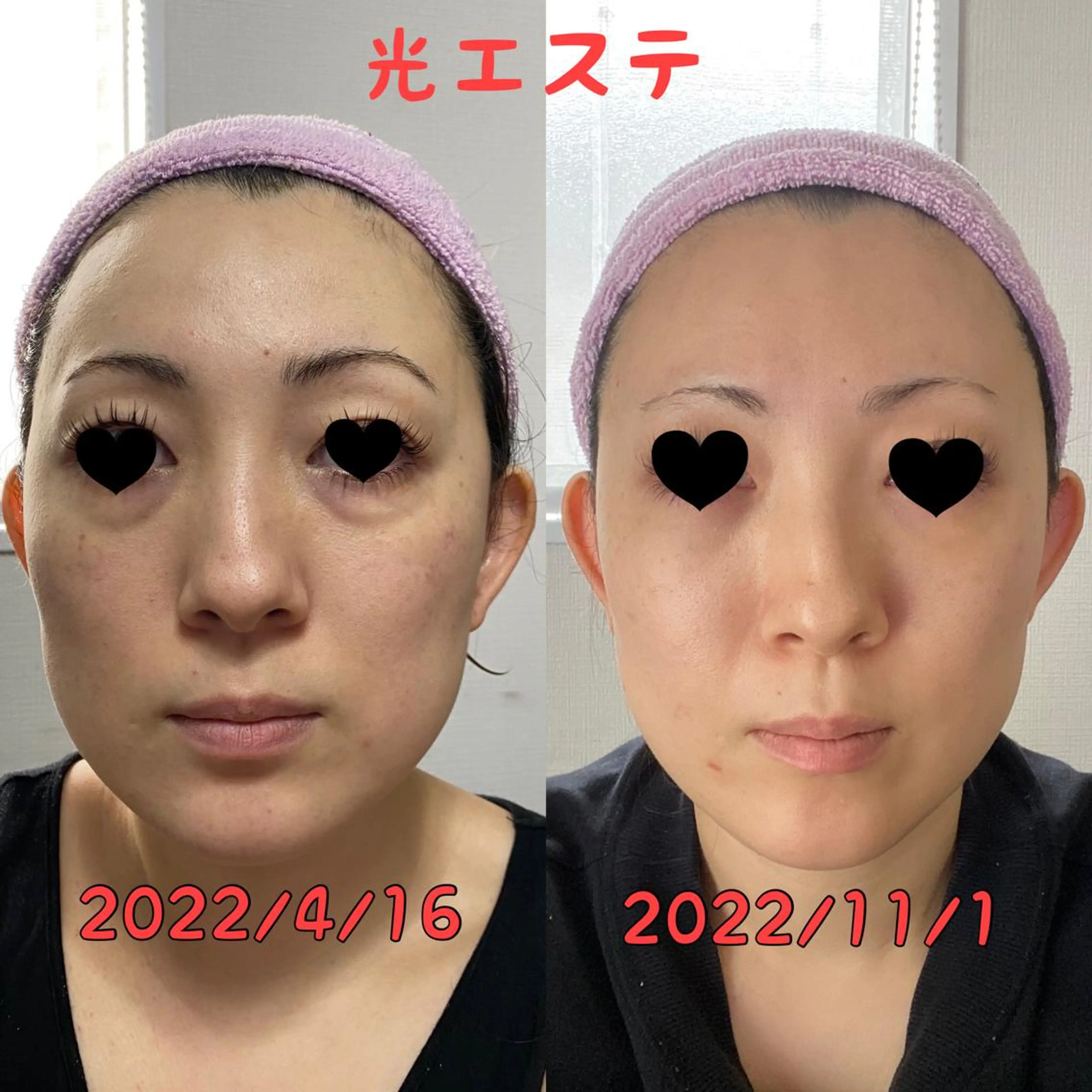 光フェイシャル✨しみ、しわ、リフトアップ、ニキビ、ニキビ跡、くすみ、赤ら顔⤴️の写真