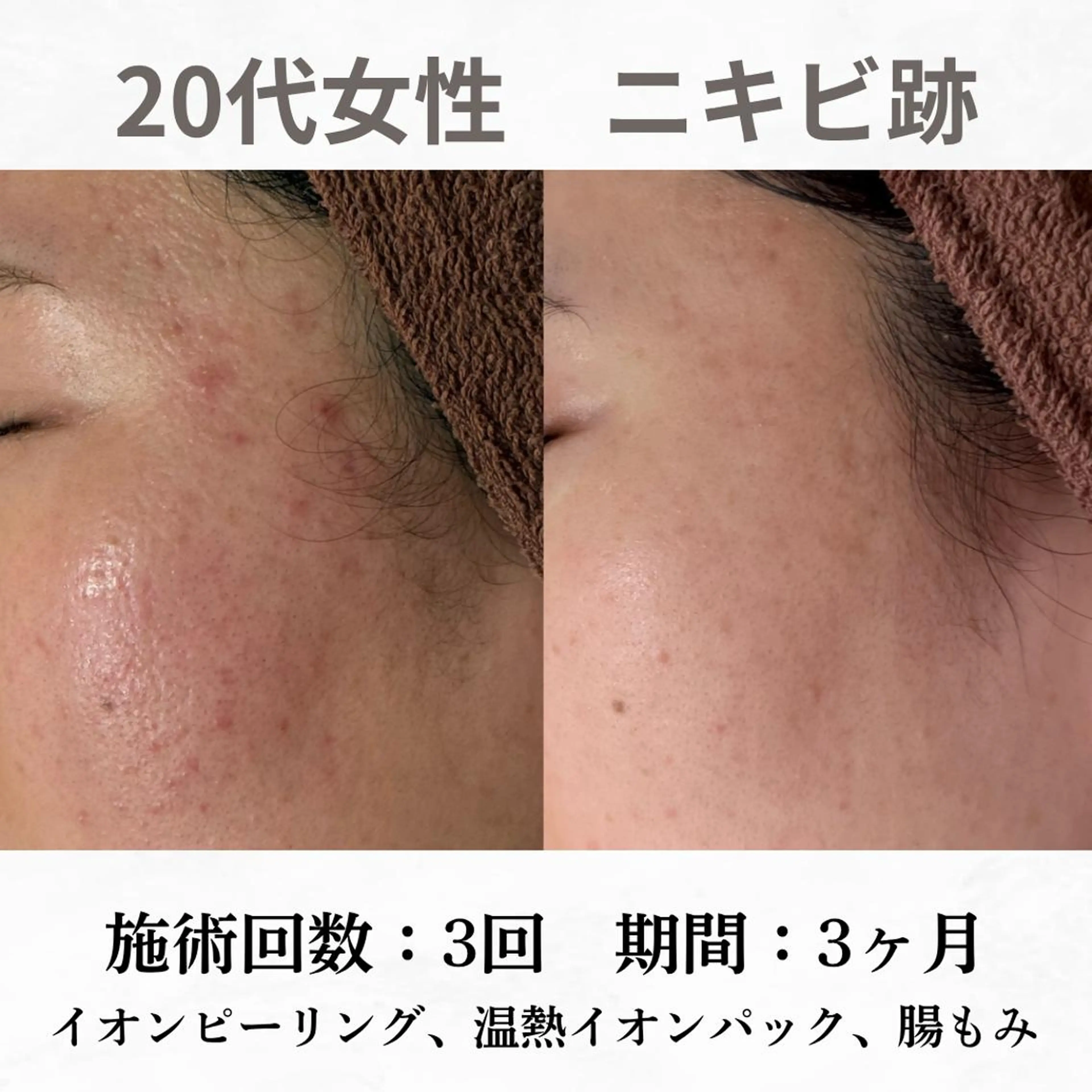 重度ニキビ専門🌷 ダウンタイムなしのエステ・リラクイメージ