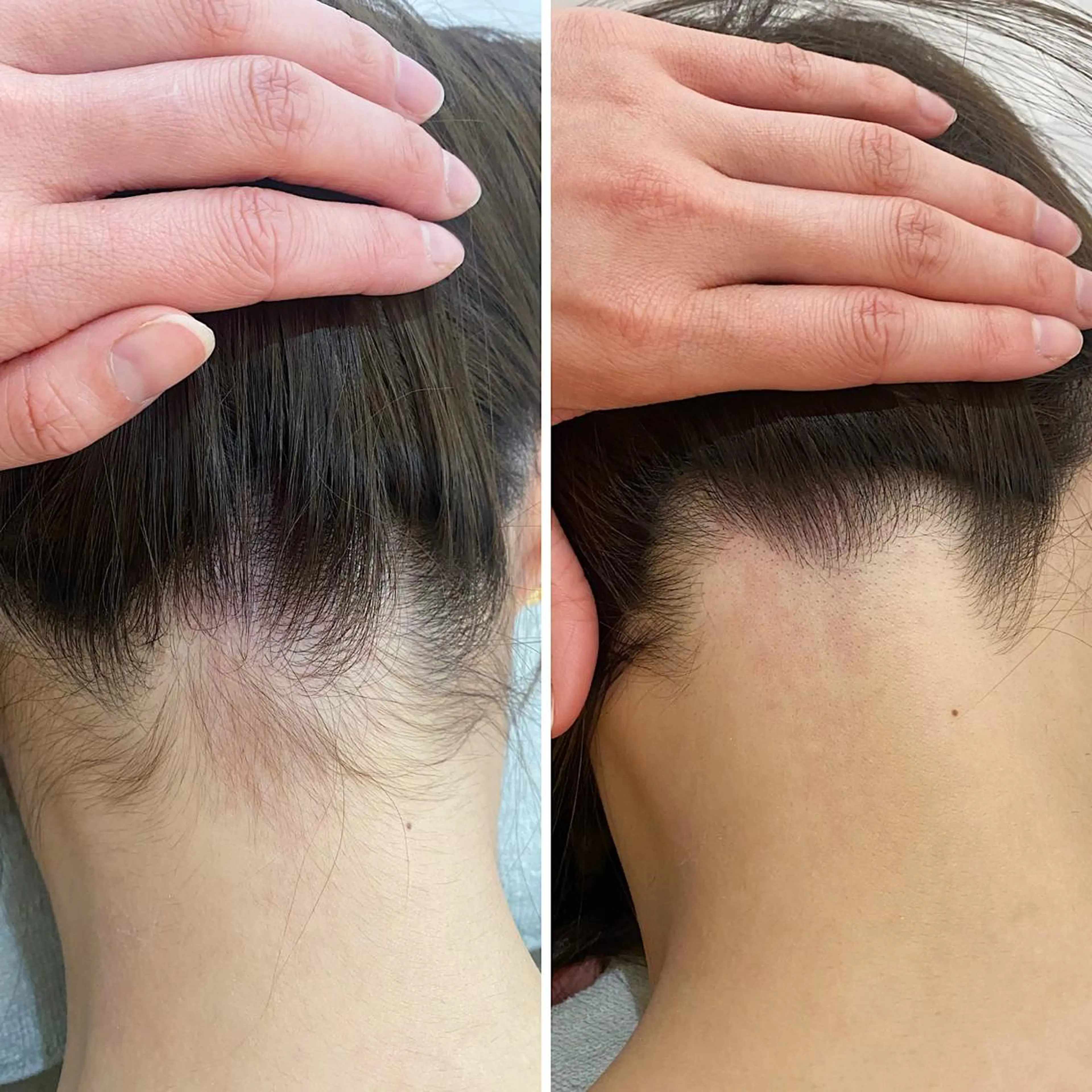 脱毛 うなじ脱毛/美肌脱毛 LABELのエステ・リラクイメージ