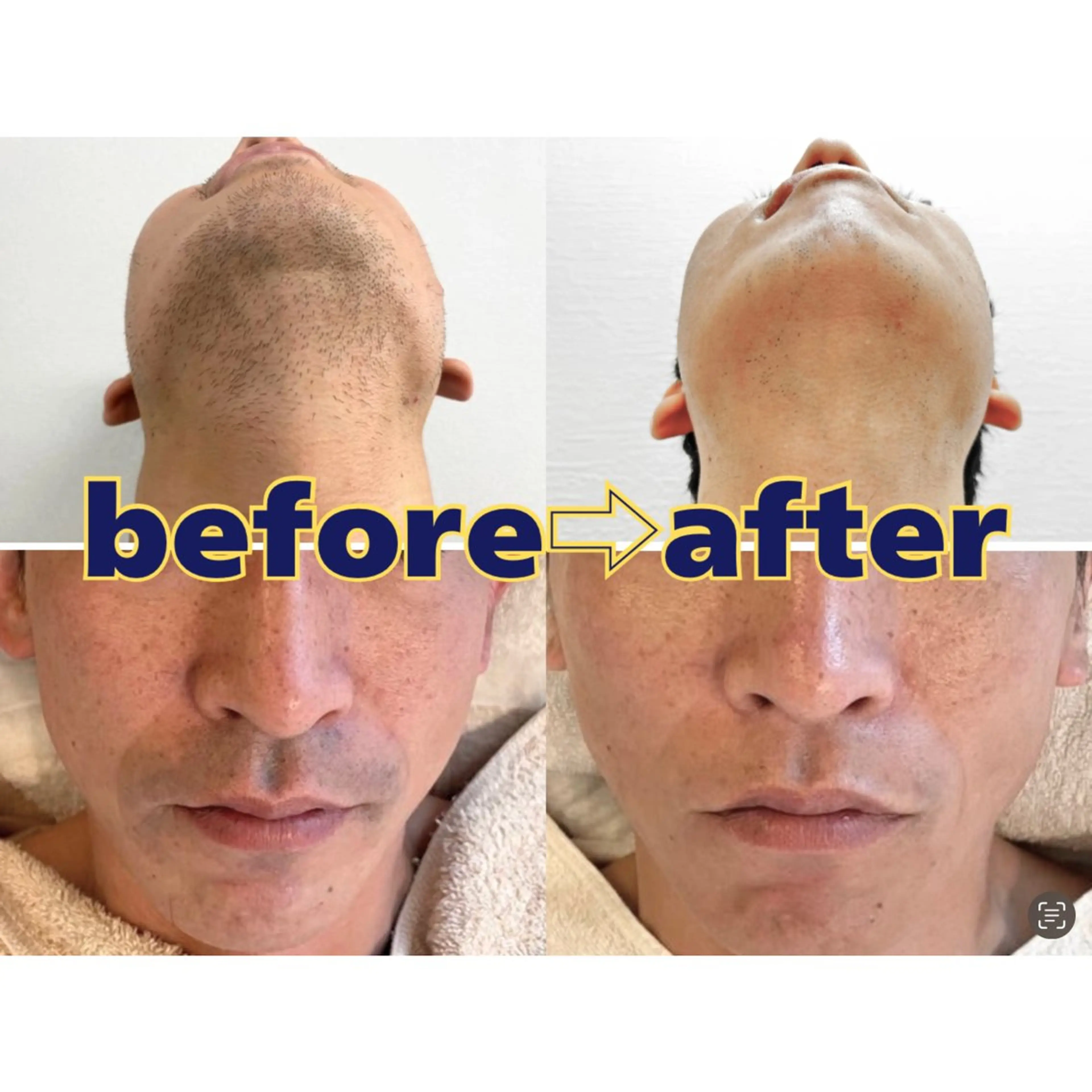 脱毛 セルフ脱毛/美尻イス キングスサロン熊本のエステ・リラクイメージ