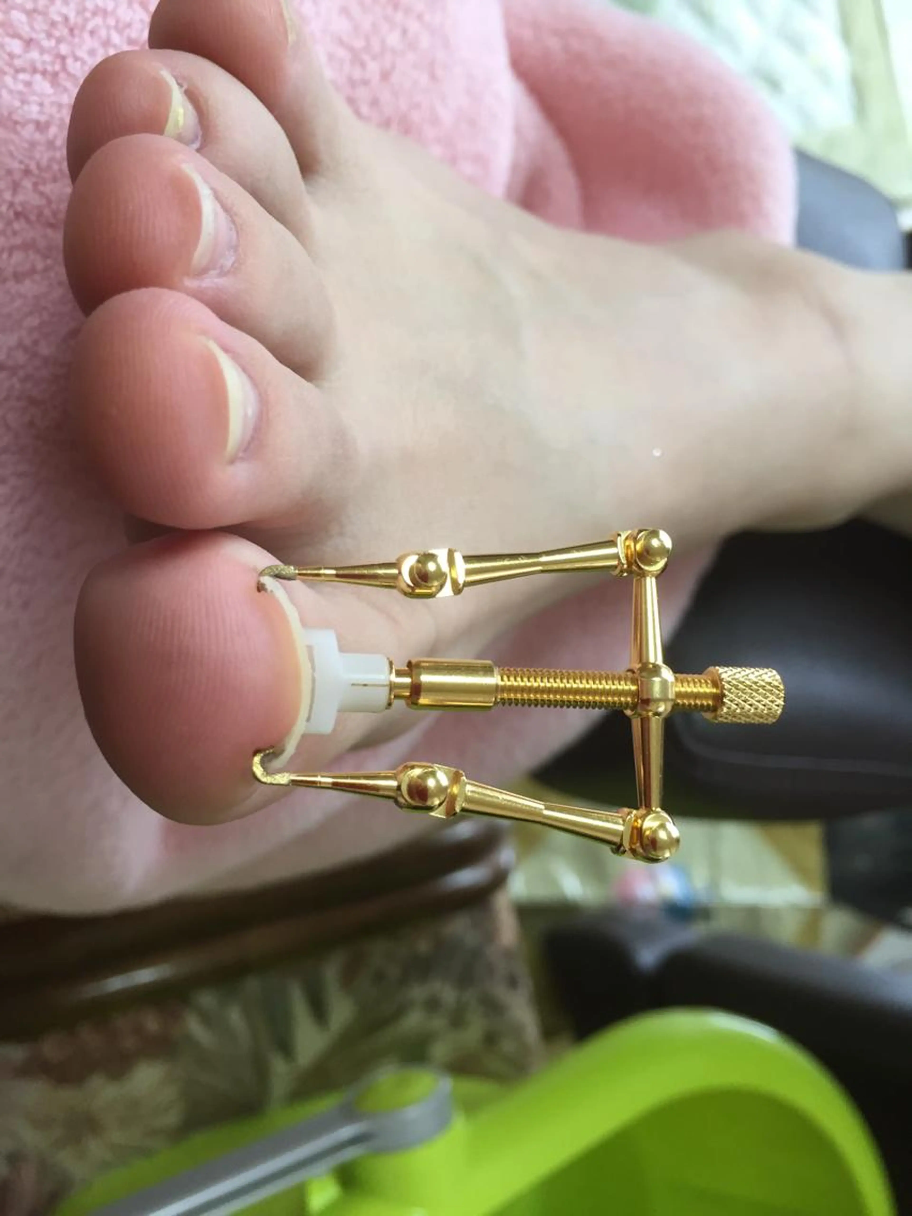 巻き爪ケア(ロホプロケアシステム)2趾の写真