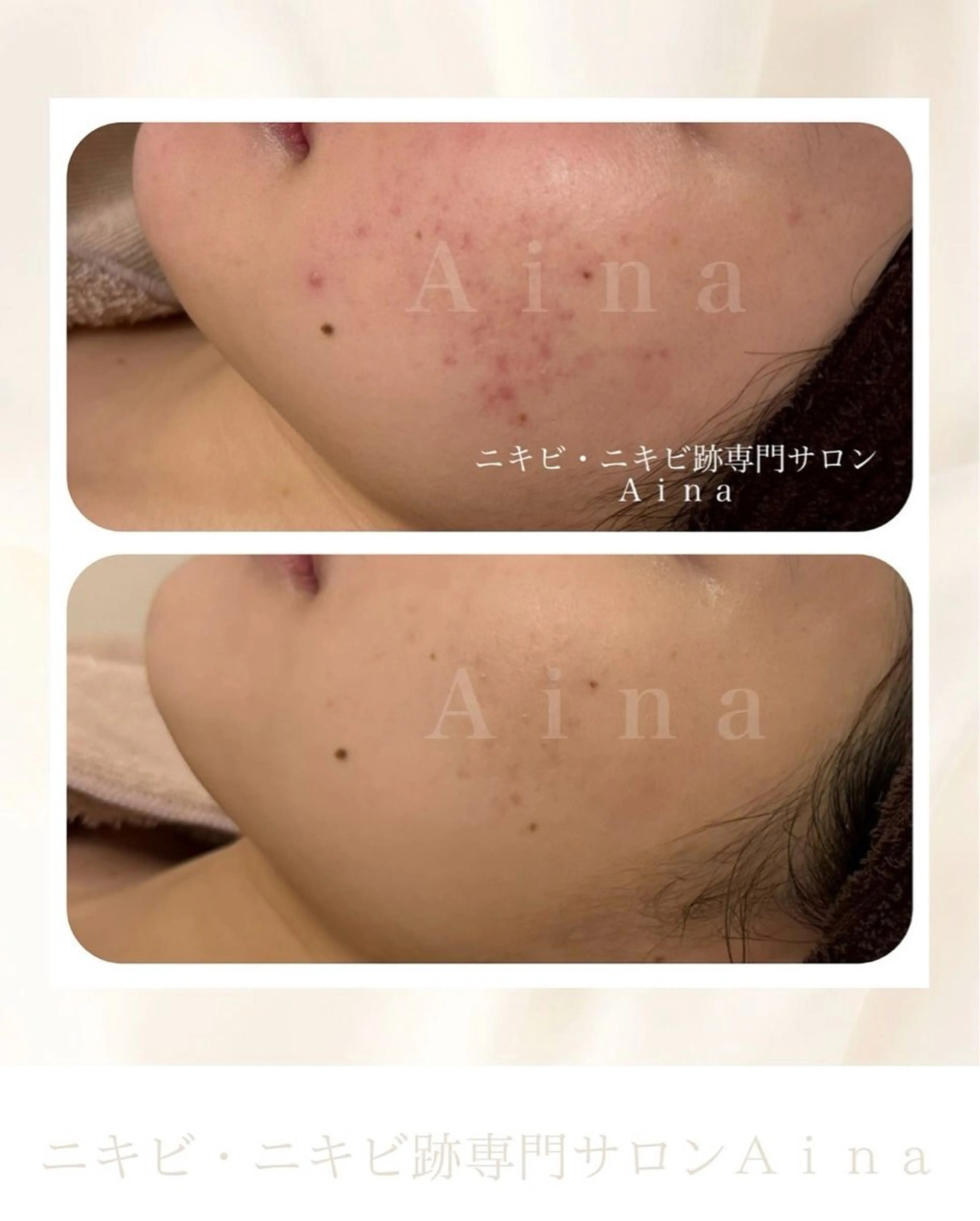 エステ リラク ニキビ跡専門サロン Ａｉｎａのエステ・リラクイメージ