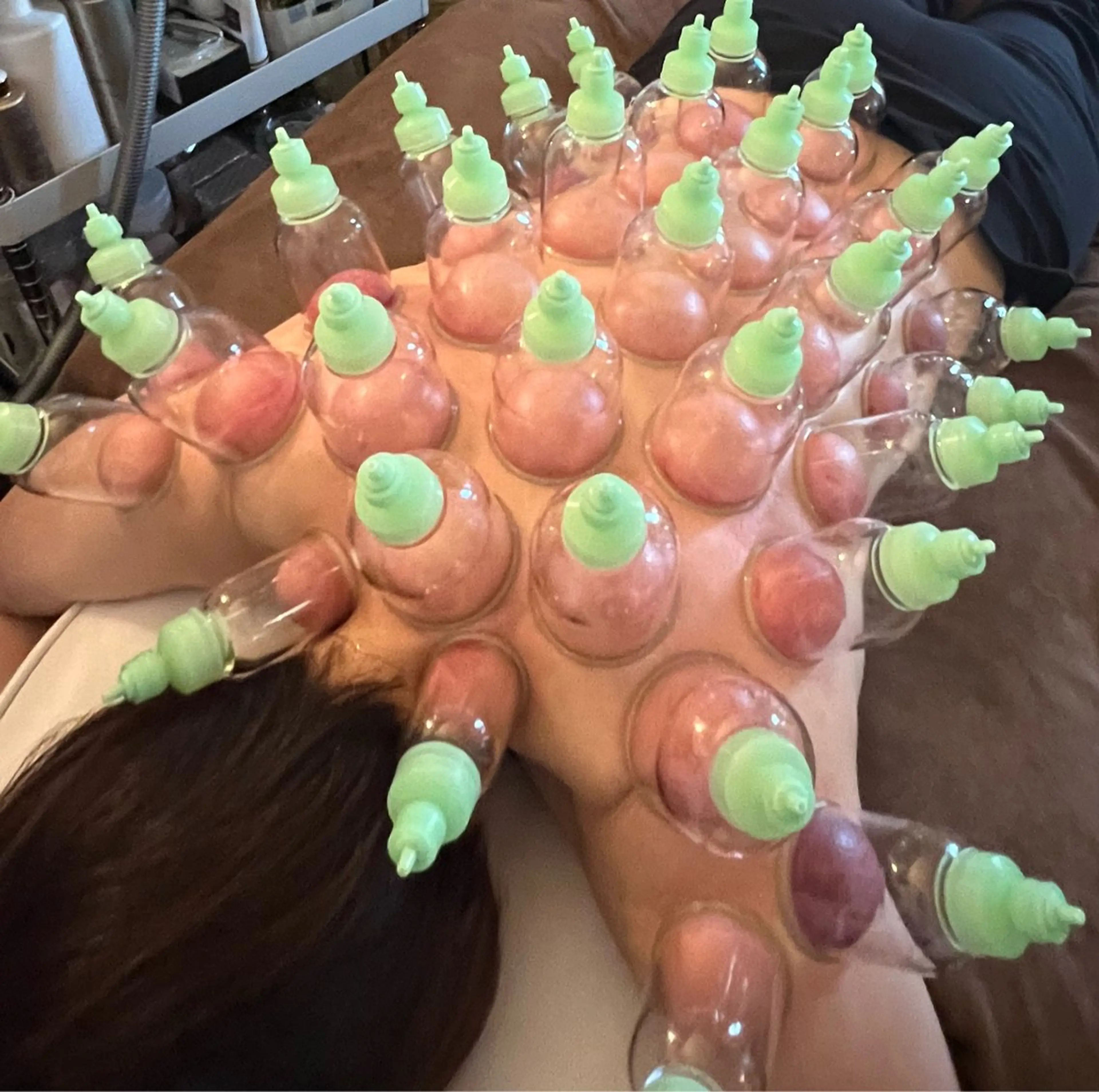 全身デトックス!カッピング(片面 : 背中・足)メンズもOKの写真