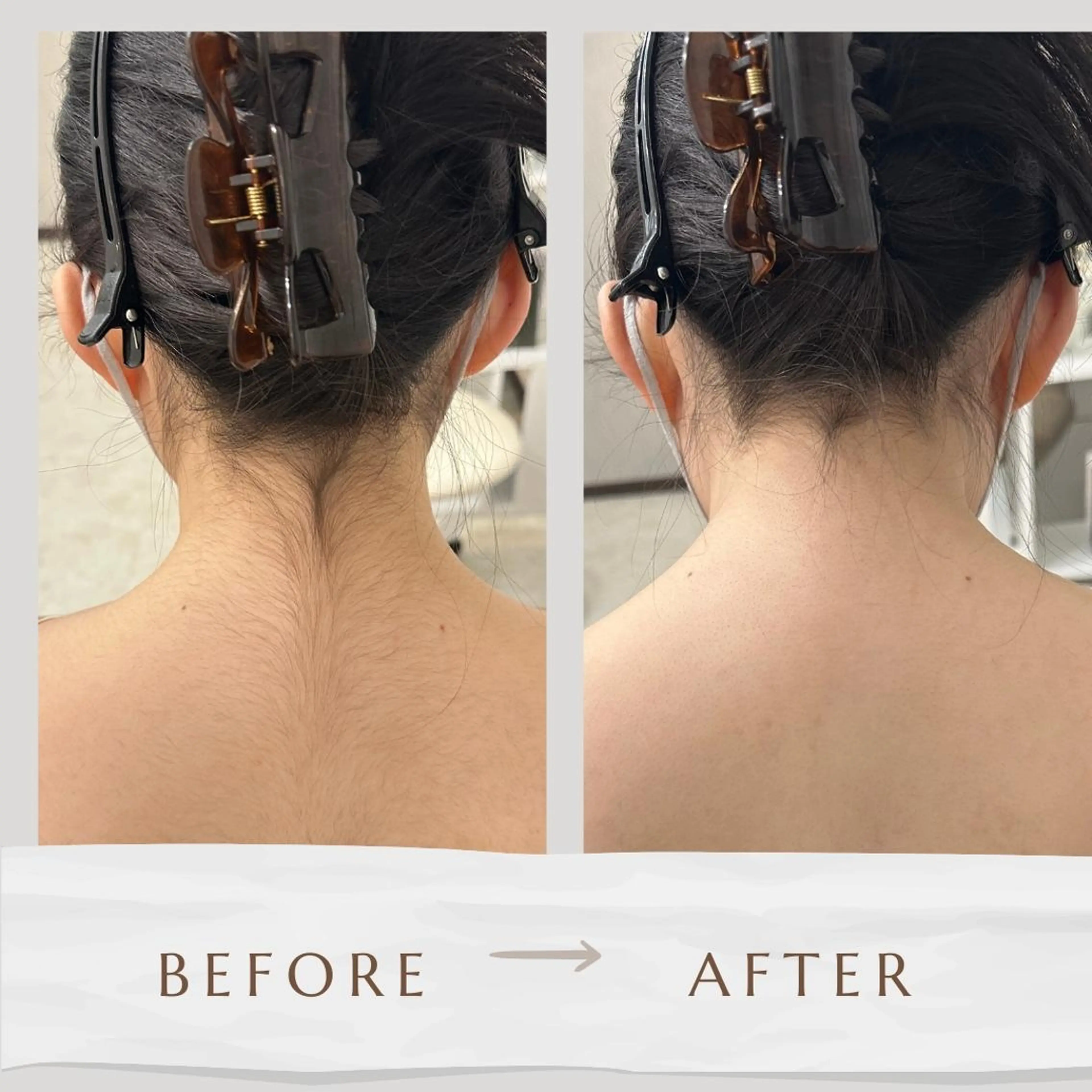 【成人式前撮り応援】顔＆もみあげ＆うなじ＆えり足ソフトシェービング／毛穴引き締めパック付きの写真