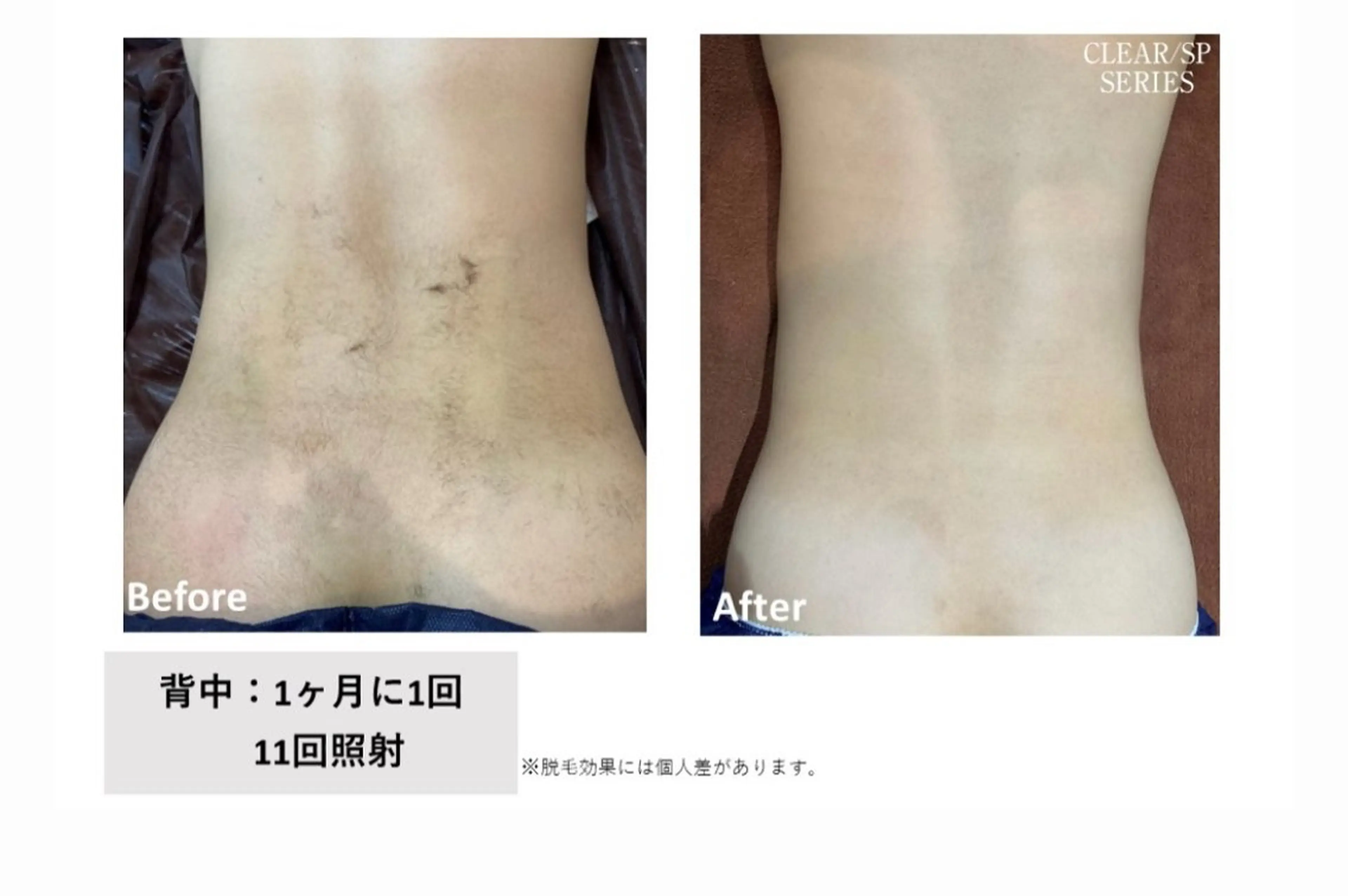 背中脱毛の写真