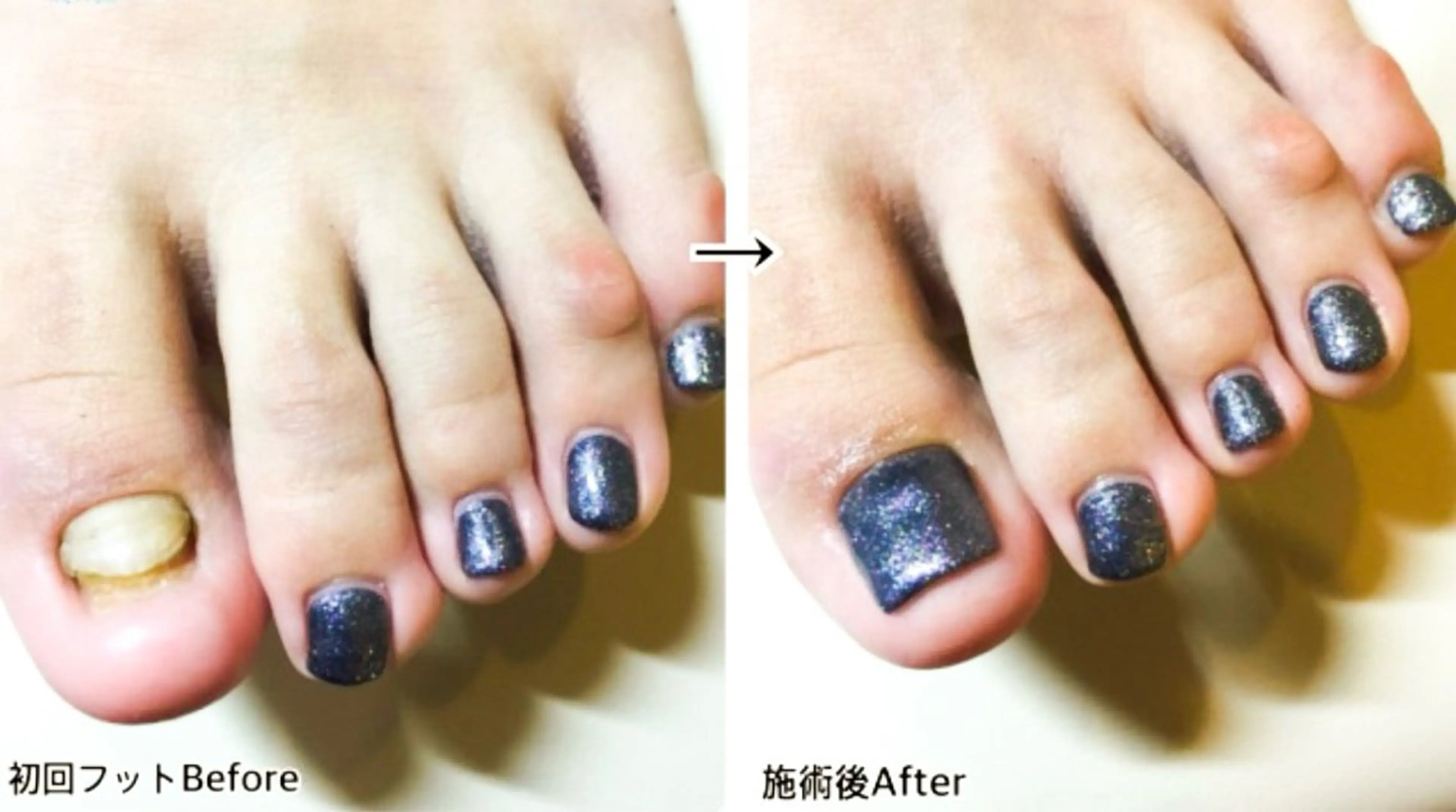 メンズ ネイル フットネイル 深爪矯正専門店　ネイルサロン　トイロ所属・ネイルサロン トイロのネイルデザイン