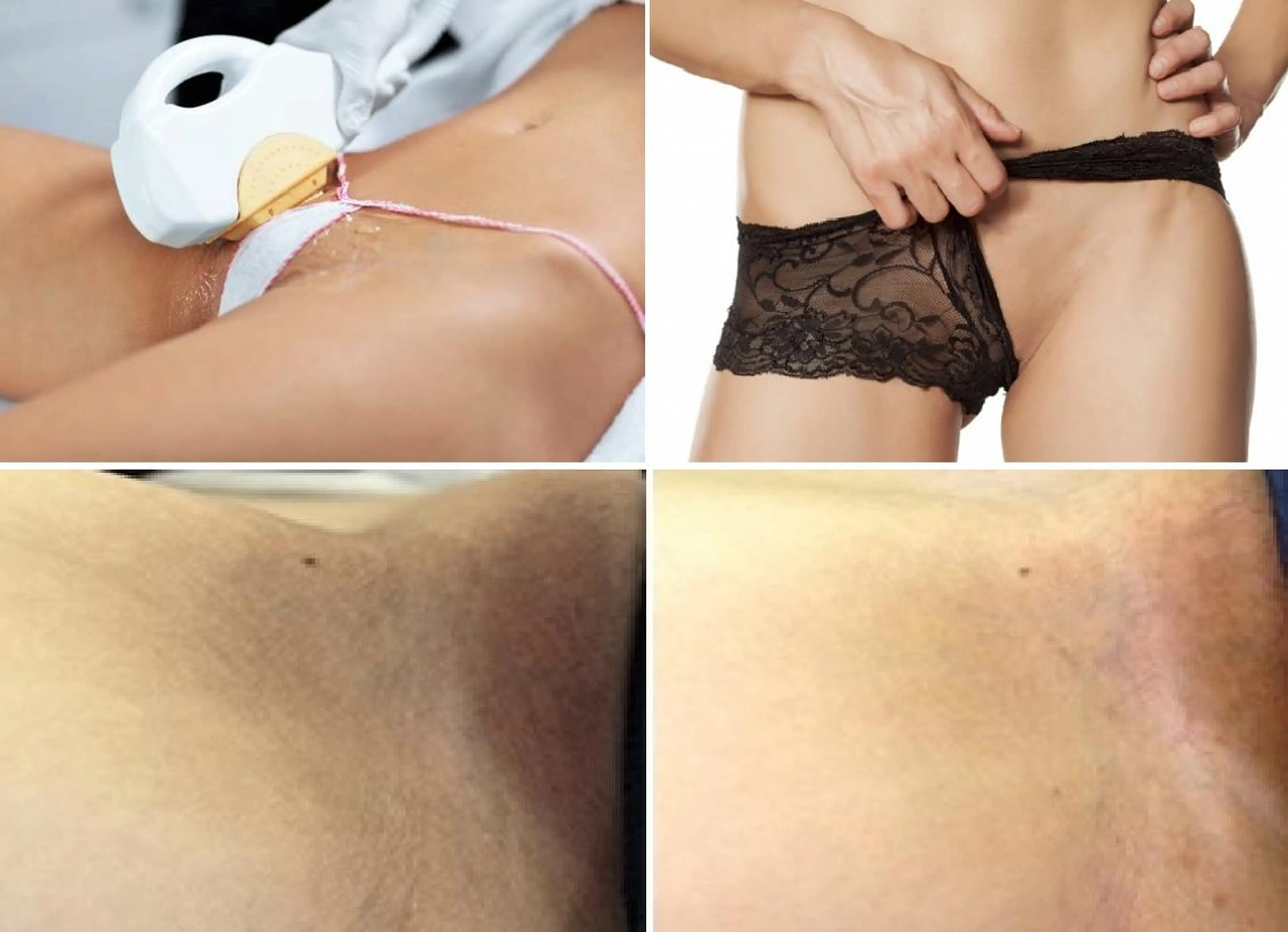 【美療VIO脱毛＋ダメージケア】エステ唯一の脱毛効果&再生トーニングで肌修正♪2回目以降はVIO脱毛を全回数無料の写真