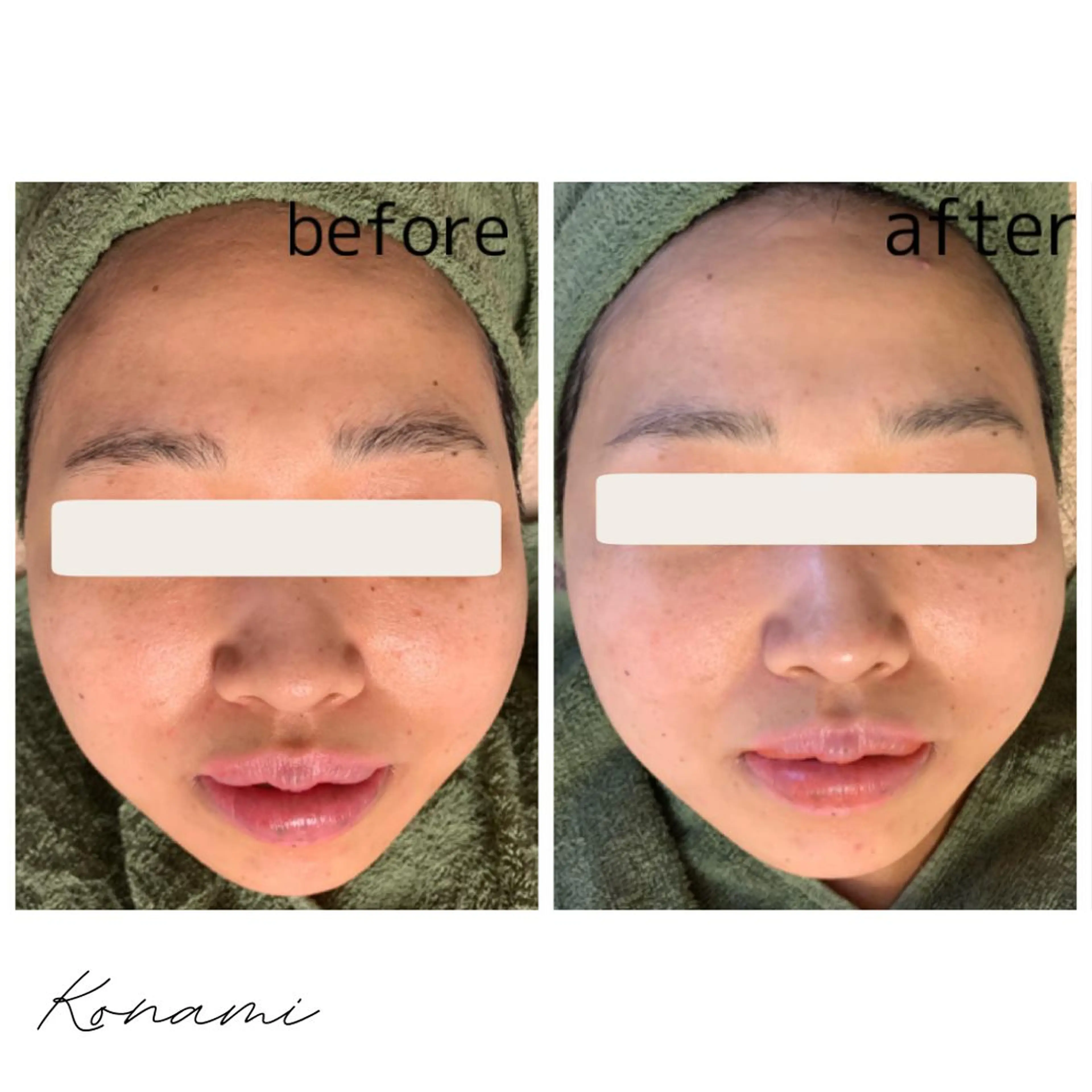 【フェイシャル】VOSサロンケアの写真