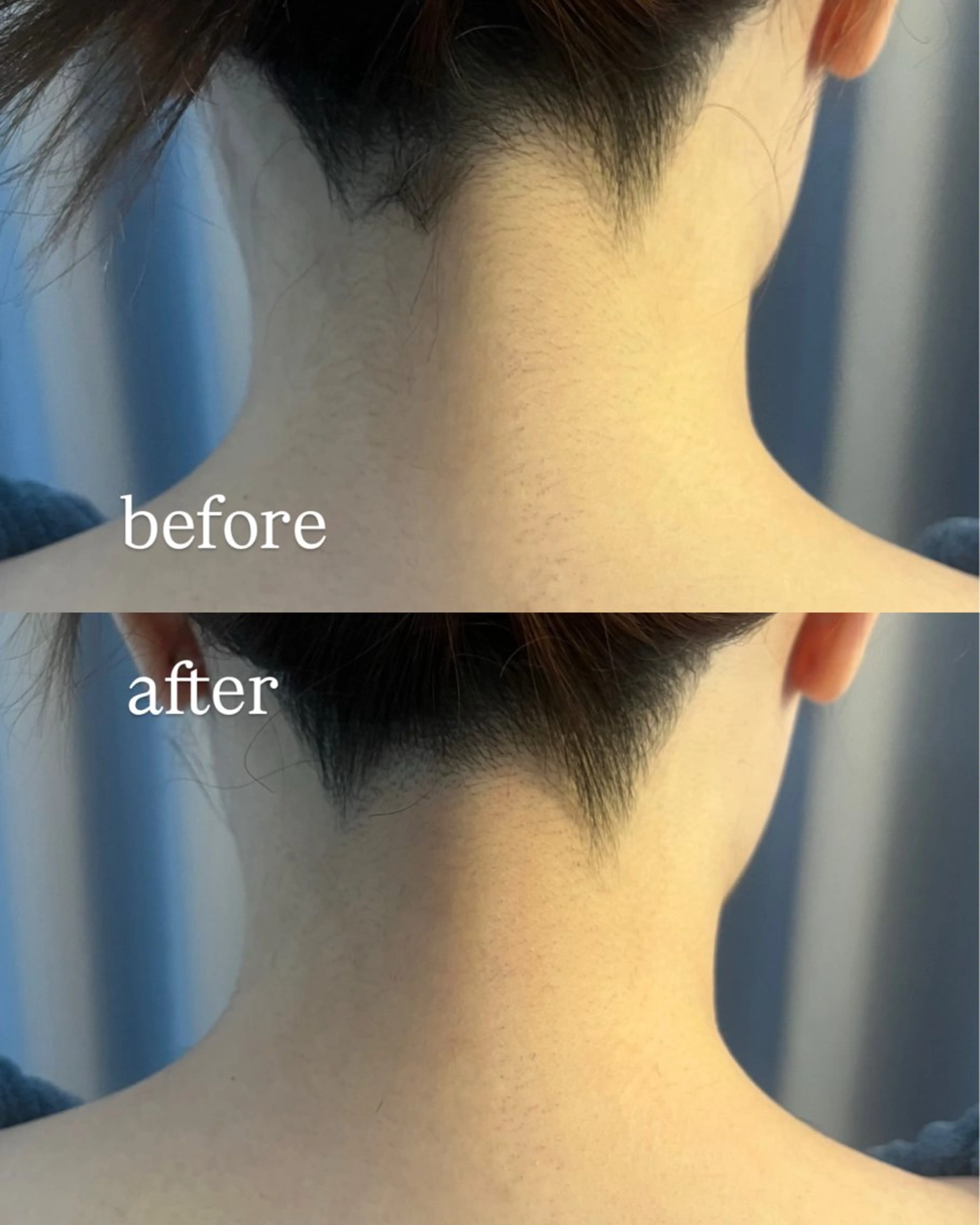 脱毛 うなじ脱毛/美肌脱毛 LABELのエステ・リラクイメージ