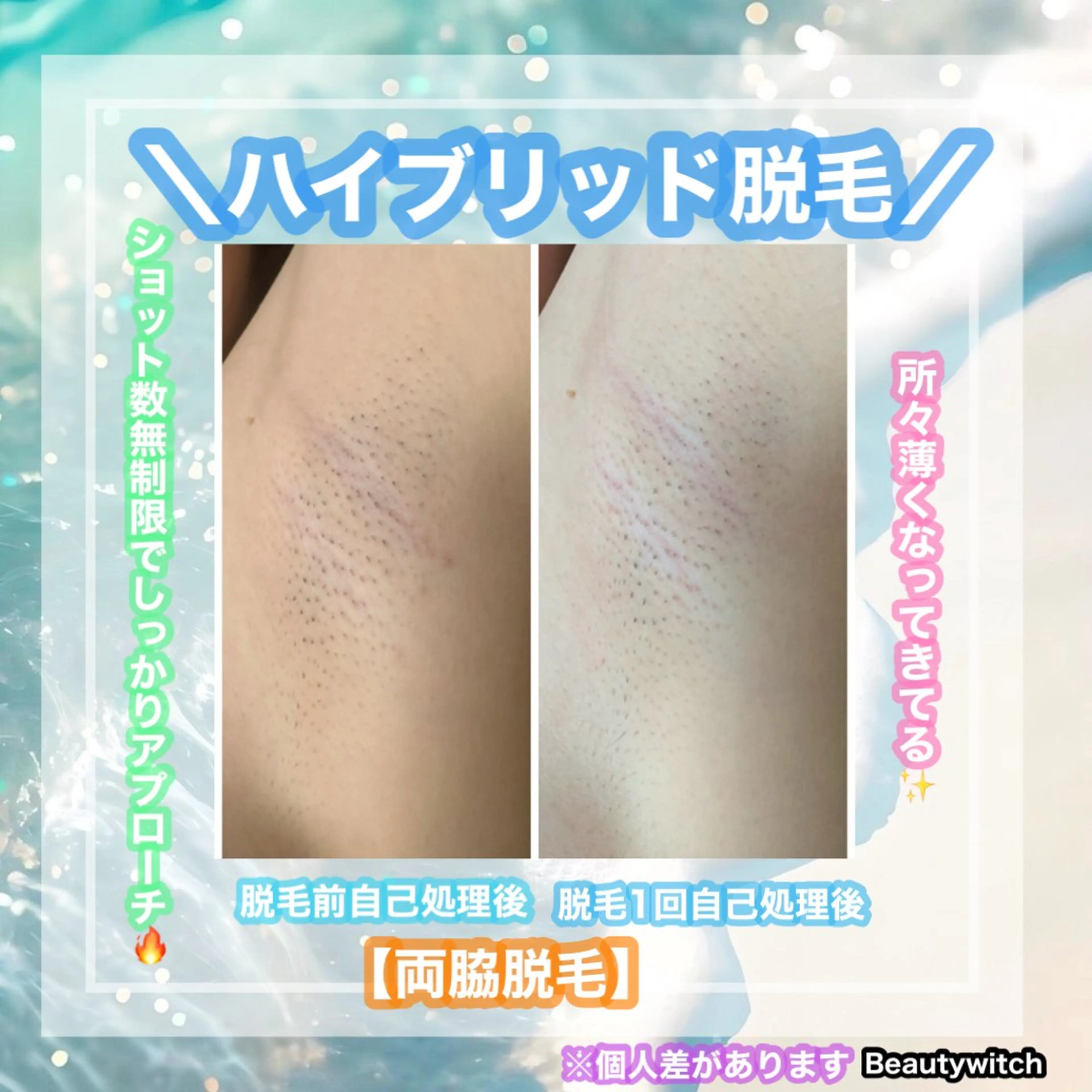 脱毛 痩身/脱毛/ネイル HARUKAのエステ・リラクイメージ