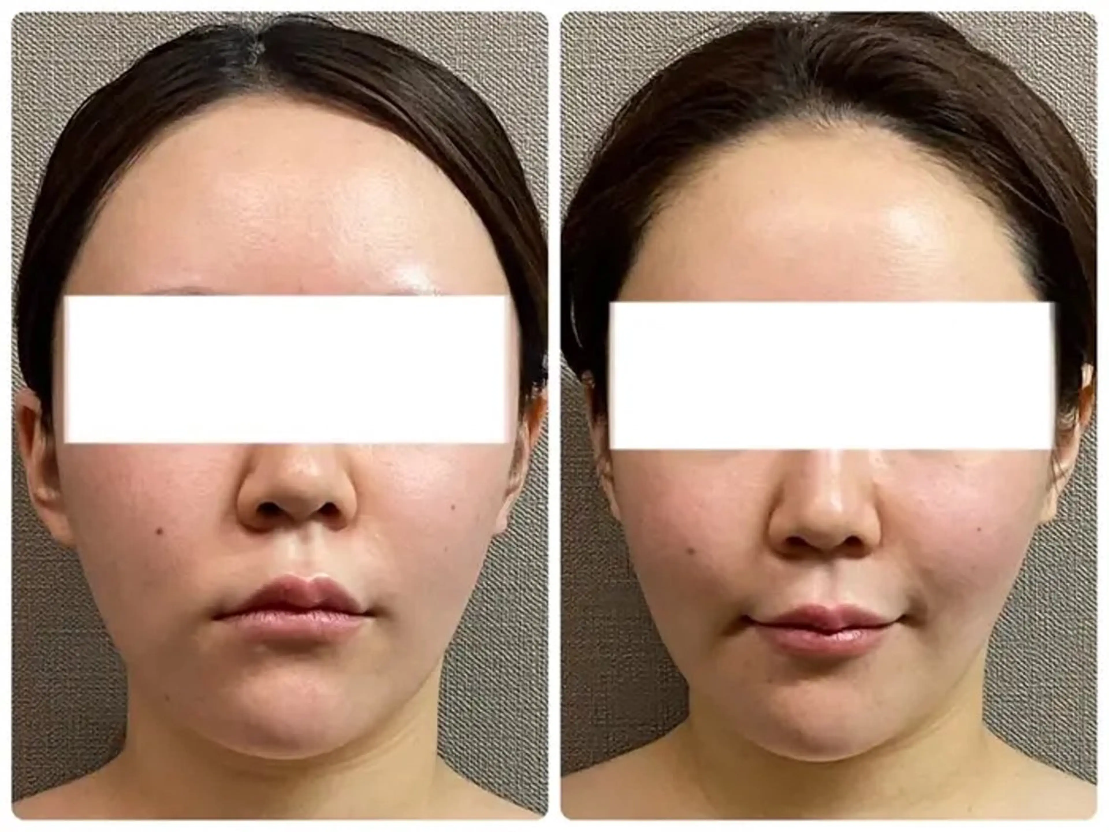 エステ通常価格【ボトックス検討中の方！】改善凝り固まったエラ頬を撃退80分【¥20,900→¥8,800】の写真