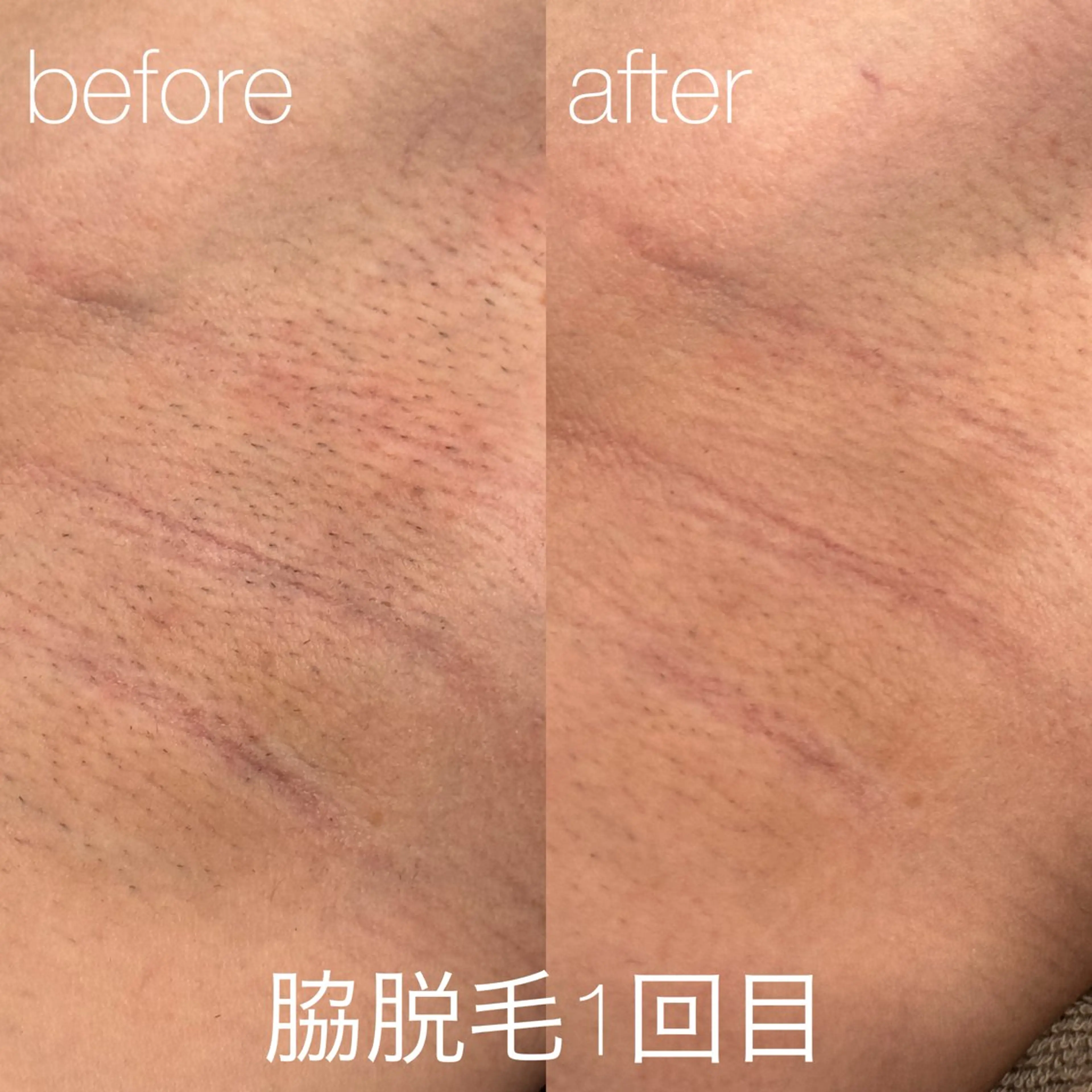 【メンズ♂】全身脱毛の写真