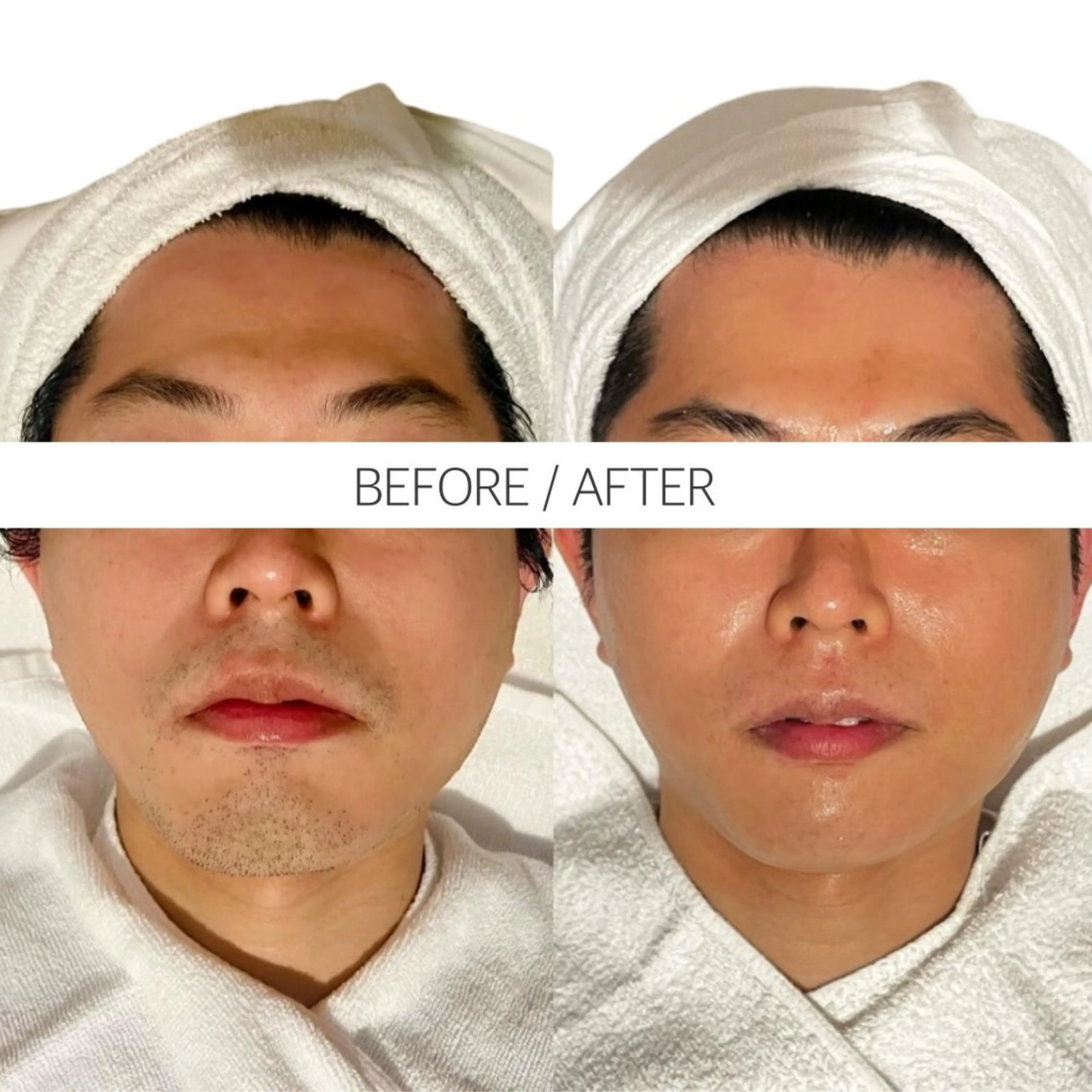 【ミニモ学割U24🏫】毛穴洗浄＋ヒゲ脱毛　¥3,980の写真