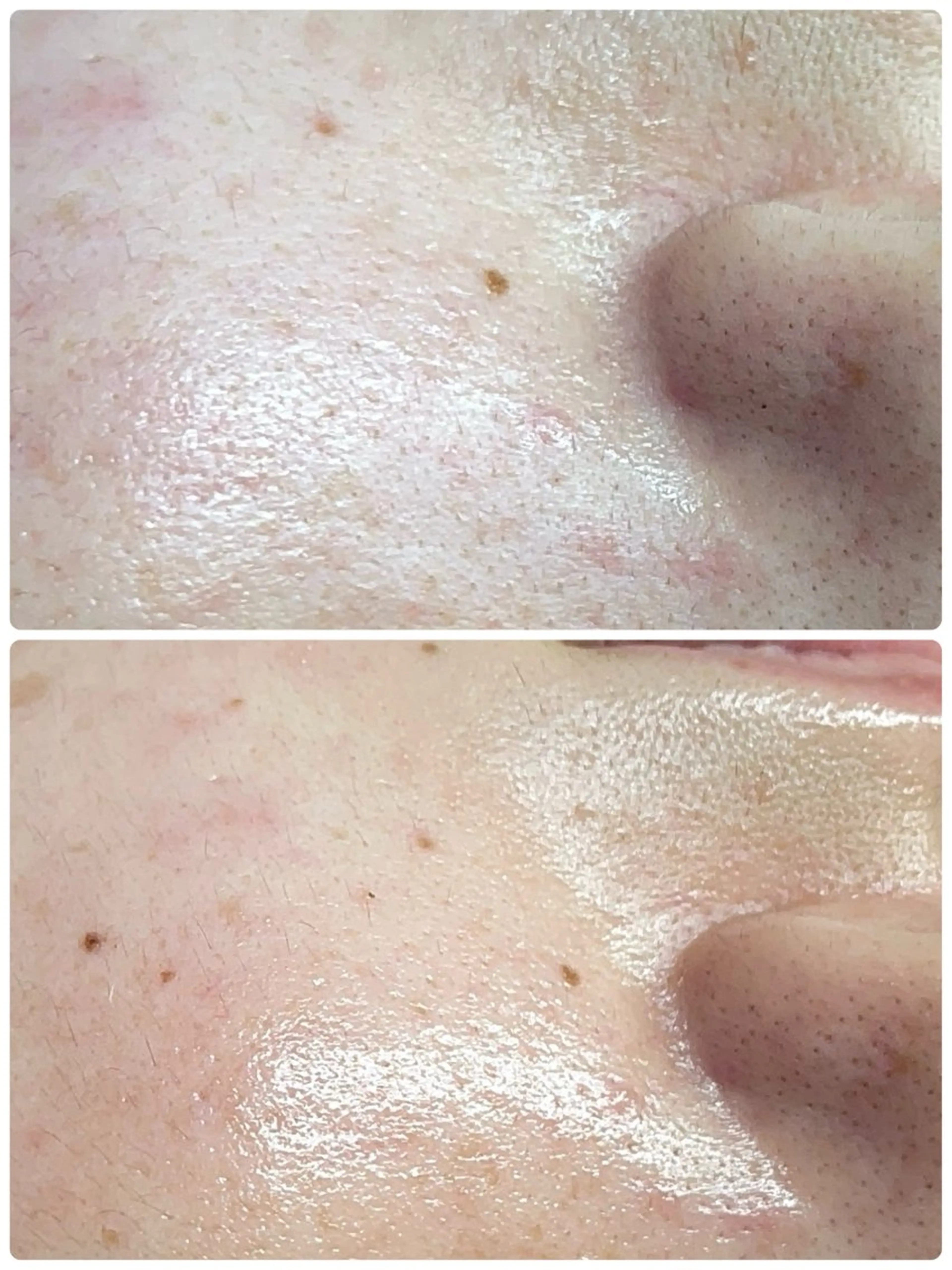 エステ Chalon所属・REVI取扱・肌悩み 毛穴Chalonのエステ・リラクイメージ